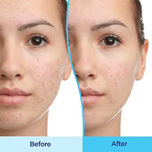 Differin Acne Treatment Gel, 30 Day Supply, Retinoid Treatment for Face Differin buy supplements canada