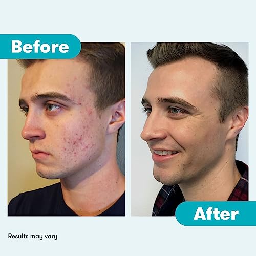 Proactiv 3 Step Acne Treatment - Benzoyl Peroxide Face Wash, Repairing Acne Spot Proactiv buy supplements canada