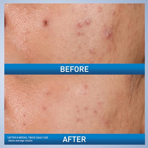 CeraVe Acne Control Gel, 2% Salicylic Acid Treatment With Glycolic Acid + Lactic Acids CeraVe buy supplements canada