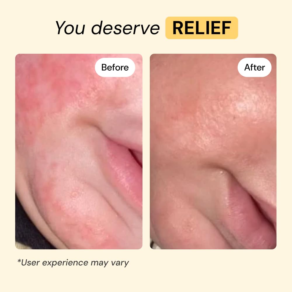 MyMagicHealer Universal Flare Care | Essential Oil Free | Baby Dermatitis, Diaper Rash, Eczema, Psoriasis, Impetigo | Wound Car MyMagicHealer buy supplements canada