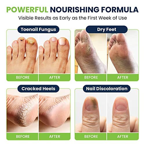 Toenail Fungus Treatment Extra Strength - Advance nail fungus treatment for fingernails FOOT CURE buy supplements canada