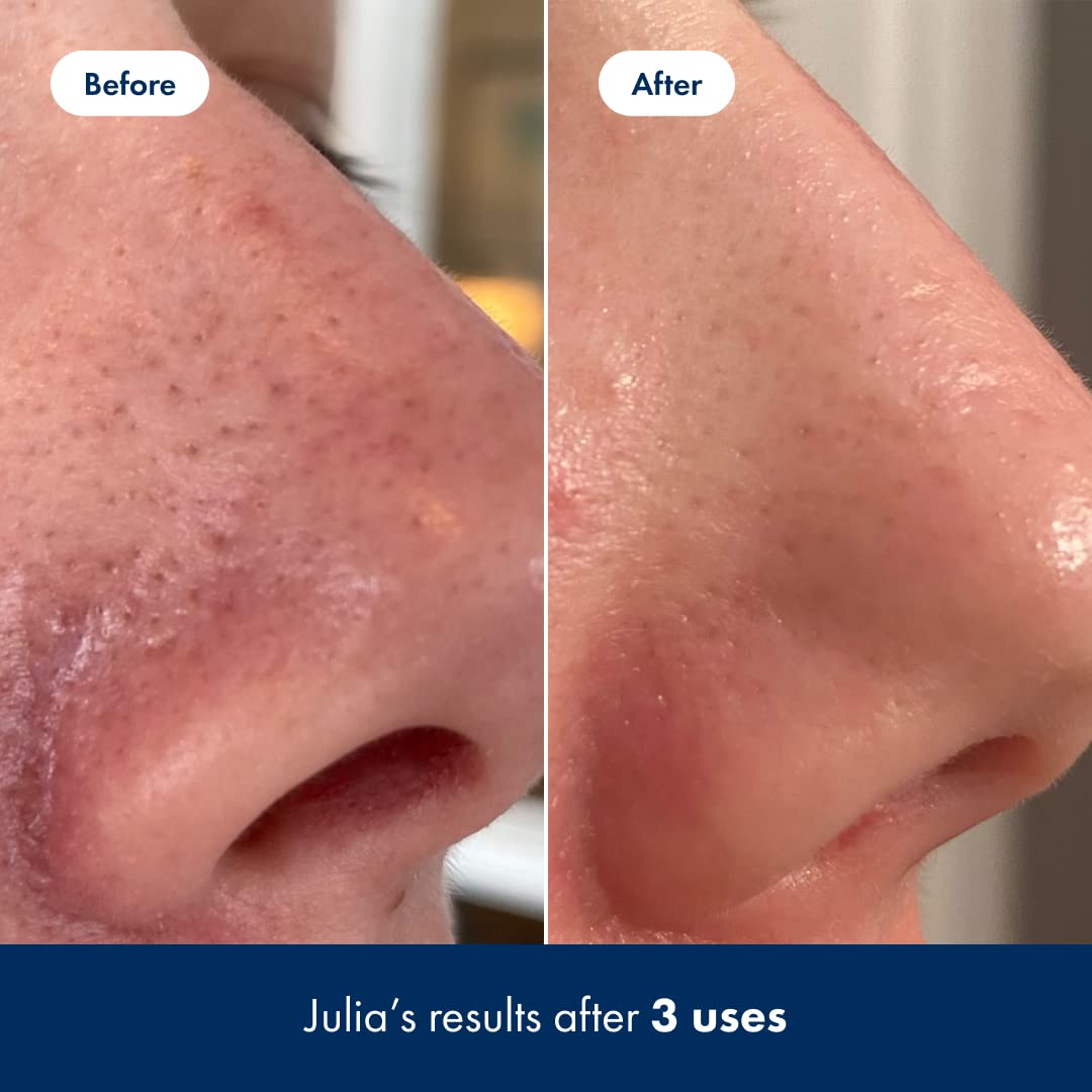Hero Cosmetics Pore Release Blackhead Clearing Solution - Exfoliating Toner Featuring BHA HERO COSMETICS buy supplements canada