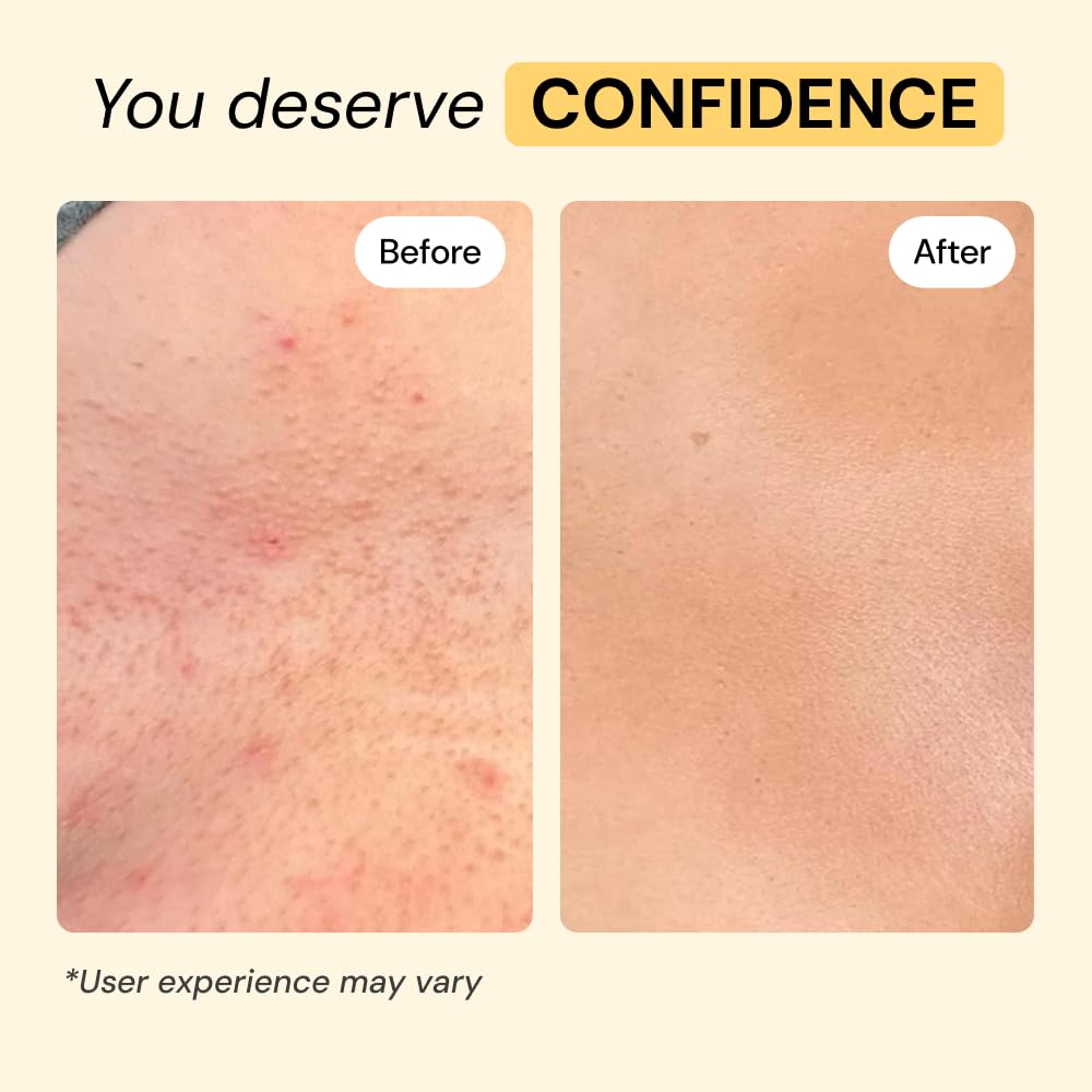 MyMagicHealer Universal Flare Care – Multi-Purpose Solution | Skin Flare-Ups - Hidradenitis Suppurativa, Folliculitis, Boils, Cysts MyMagicHealer buy supplements canada