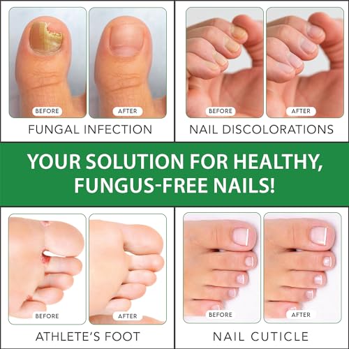 Viking Revolution Toenail Fungus Treatment Extra Strength with 1% Tolnaftate OTC Viking Revolution buy supplements canada