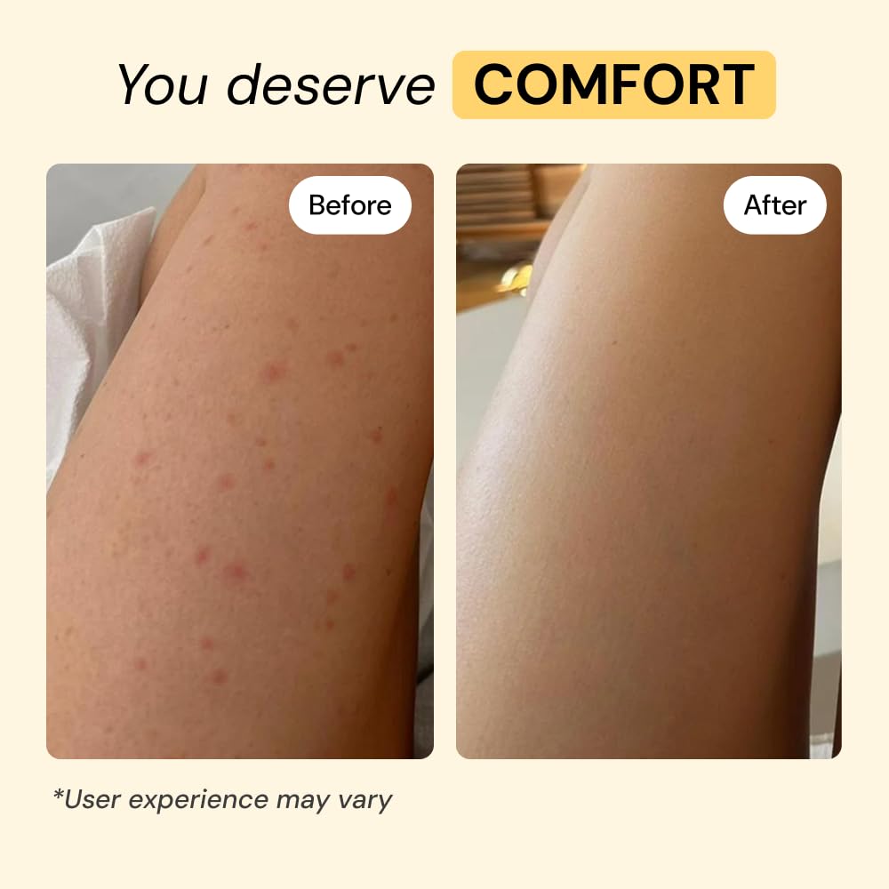 MyMagicHealer Thyme & Tea Tree Flare Care | Cystic Acne, Folliculitis, Ingrown Hair, Keratosis Pilaris, Razor Bumps, Body Bumps, Blind Pimples Multi-purpose Solution MyMagicHealer buy supplements canada