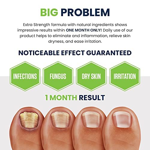 Toenail Fungus Treatment Extra Strength - Advance nail fungus treatment for fingernails FOOT CURE buy supplements canada