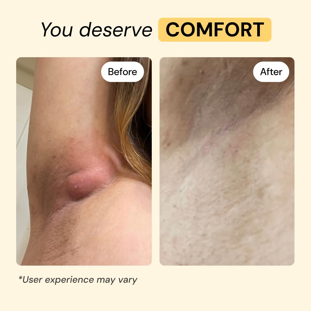 MyMagicHealer Universal Flare Care – Multi-Purpose Solution | Skin Flare-Ups - Hidradenitis Suppurativa, Folliculitis, Boils, Cysts MyMagicHealer buy supplements canada