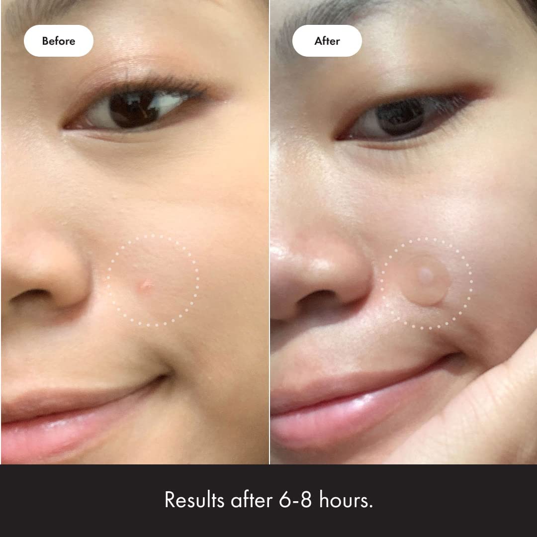 Mighty Patch Original from Hero Cosmetics - Hydrocolloid Acne Pimple Mighty Patch buy supplements canada