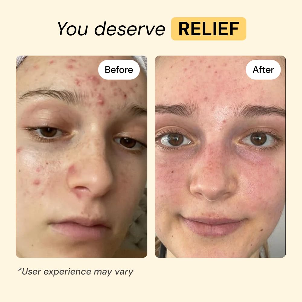 MyMagicHealer Thyme & Tea Tree Flare Care | Cystic Acne, Folliculitis, Ingrown Hair, Keratosis Pilaris, Razor Bumps, Body Bumps, Blind Pimples Multi-purpose Solution MyMagicHealer buy supplements canada