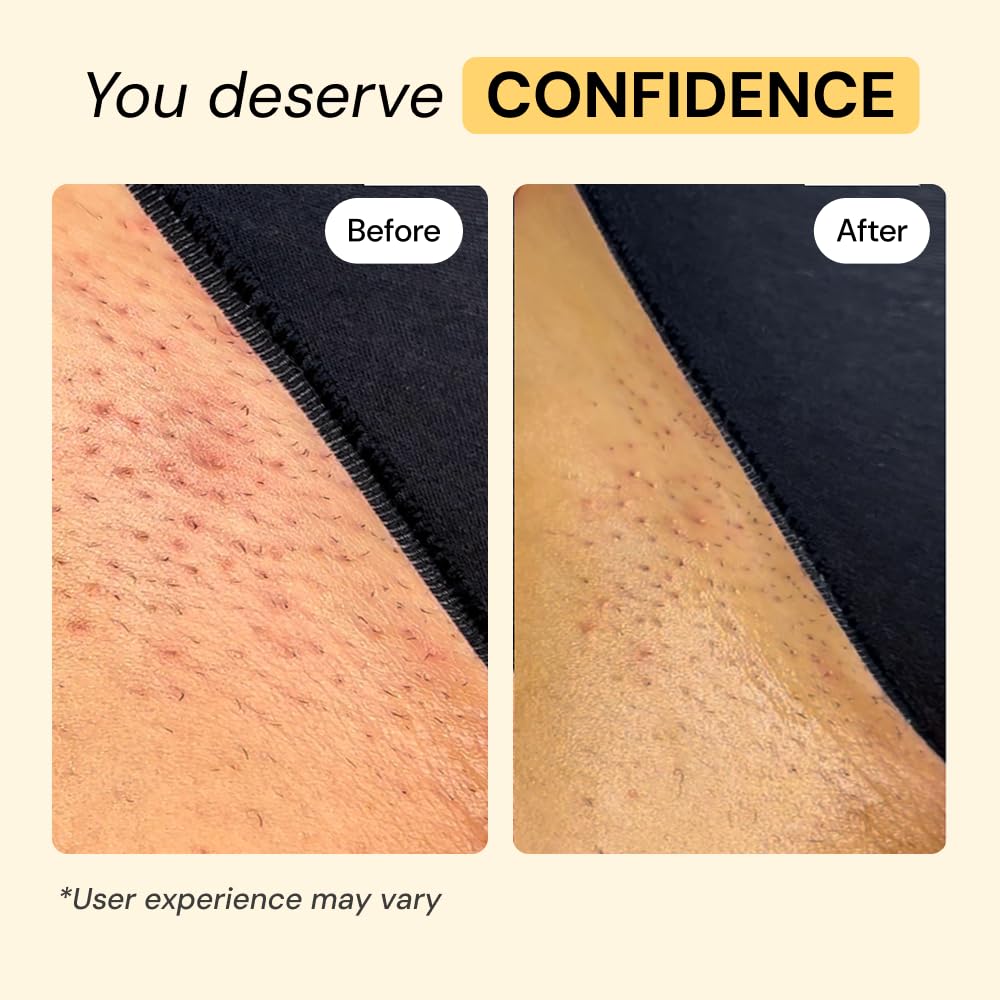 MyMagicHealer Thyme & Tea Tree Flare Care | Cystic Acne, Folliculitis, Ingrown Hair, Keratosis Pilaris, Razor Bumps, Body Bumps, Blind Pimples Multi-purpose Solution MyMagicHealer buy supplements canada