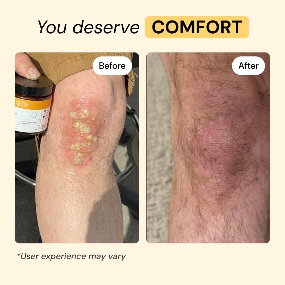 MyMagicHealer Universal Flare Care | Essential Oil Free | Baby Dermatitis, Diaper Rash, Eczema, Psoriasis, Impetigo | Wound Car MyMagicHealer buy supplements canada