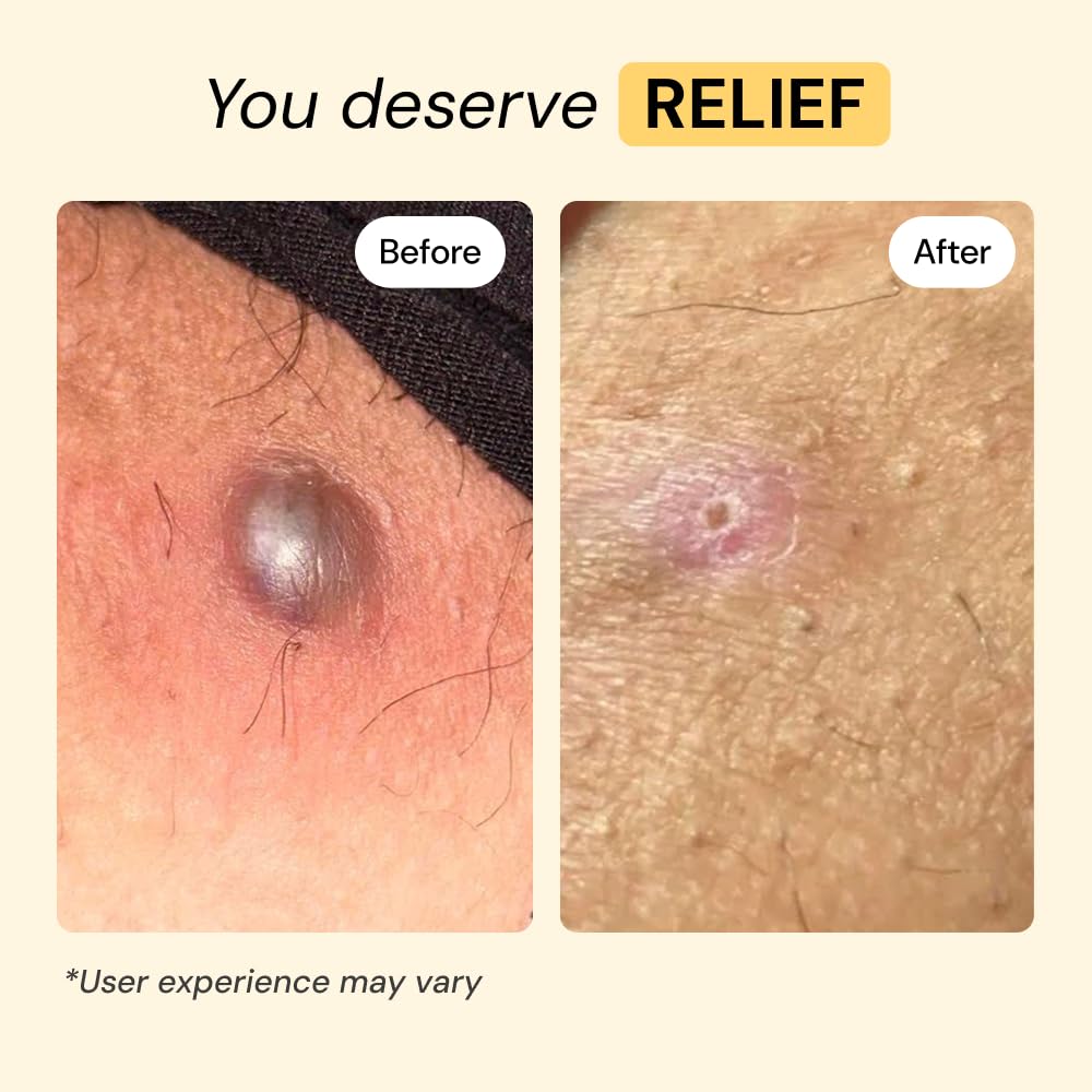 MyMagicHealer Universal Flare Care – Multi-Purpose Solution | Skin Flare-Ups - Hidradenitis Suppurativa, Folliculitis, Boils, Cysts MyMagicHealer buy supplements canada