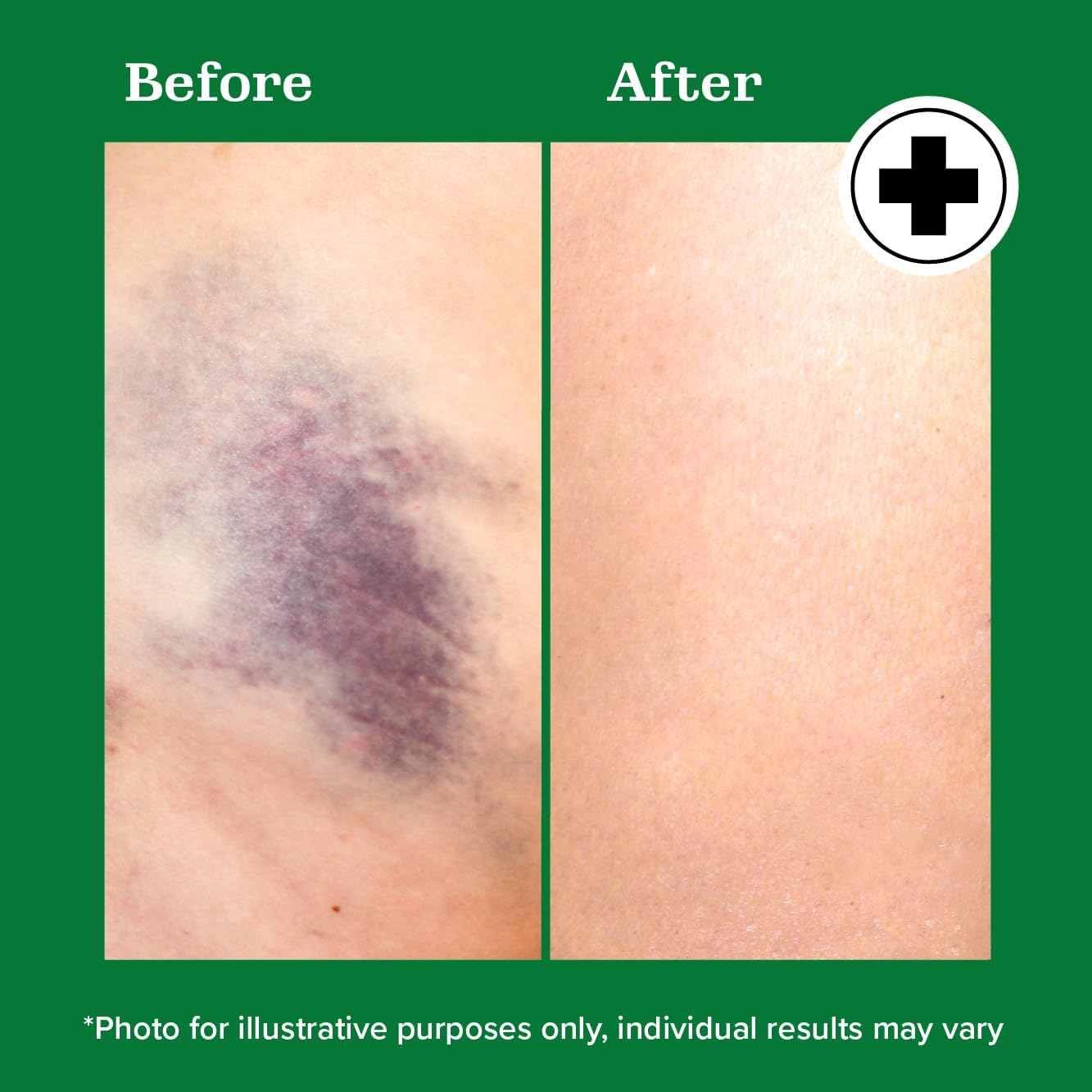 Miracle Plus Natural Arnica Bruise Gel For Body | Skin Care Arnica Montana Lotion Topical Gel | Extra Strength Vitamin K Cream Ointment, 4 Fl Oz Miracle Plus buy supplements canada
