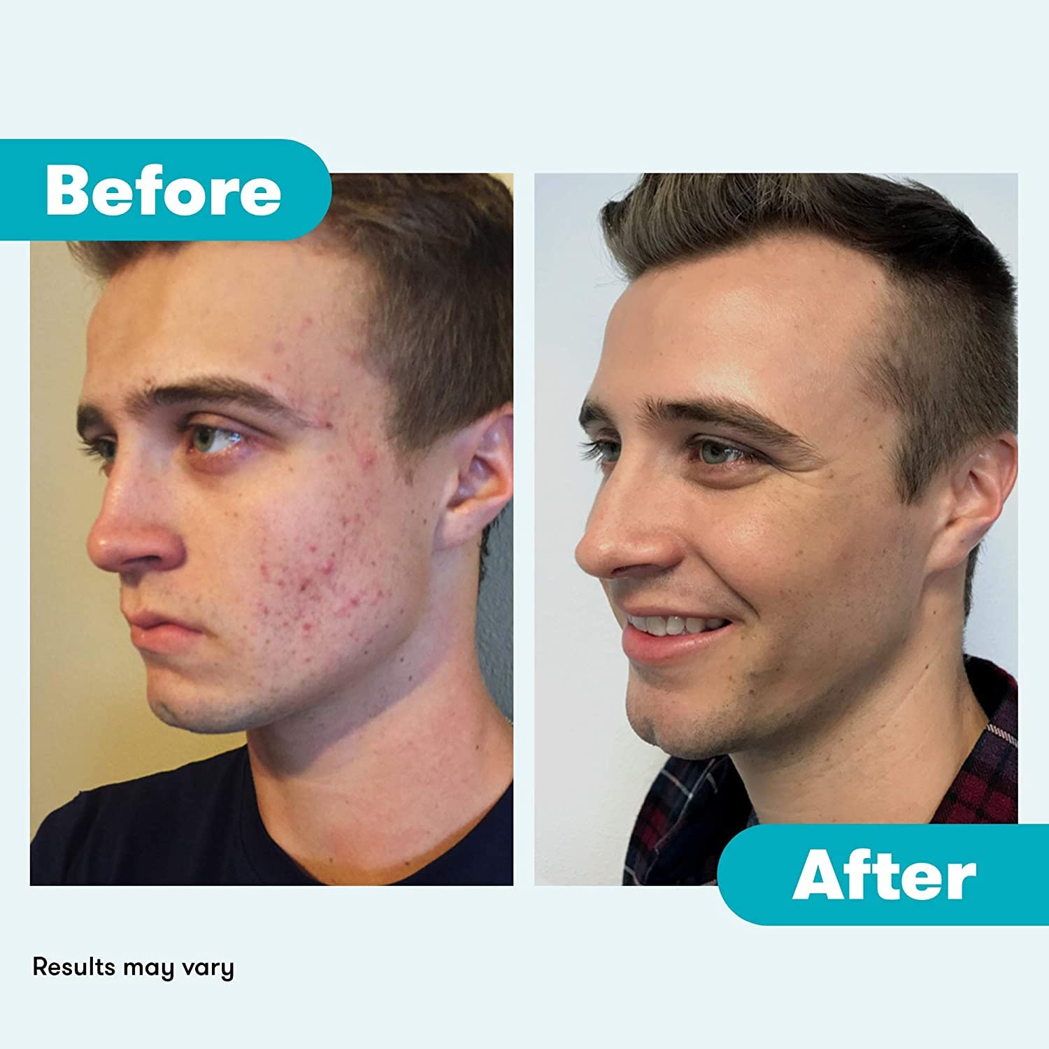 Proactiv Repair Acne Treatment Benzoyl Peroxide Spot Treatment and Repairing Serum Clear, 3 Fl Oz Proactiv buy supplements canada