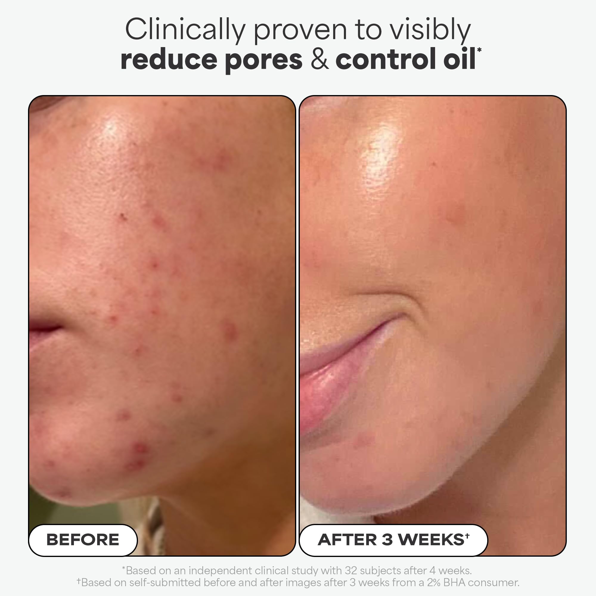 Paulas Choice--SKIN PERFECTING 2% BHA Liquid Salicylic Acid Exfoliant--Facial Exfoliant for Blackheads, Enlarged Pores, Wrinkles & Fine Lines, 4 oz Bottle Paula's Choice buy supplements canada