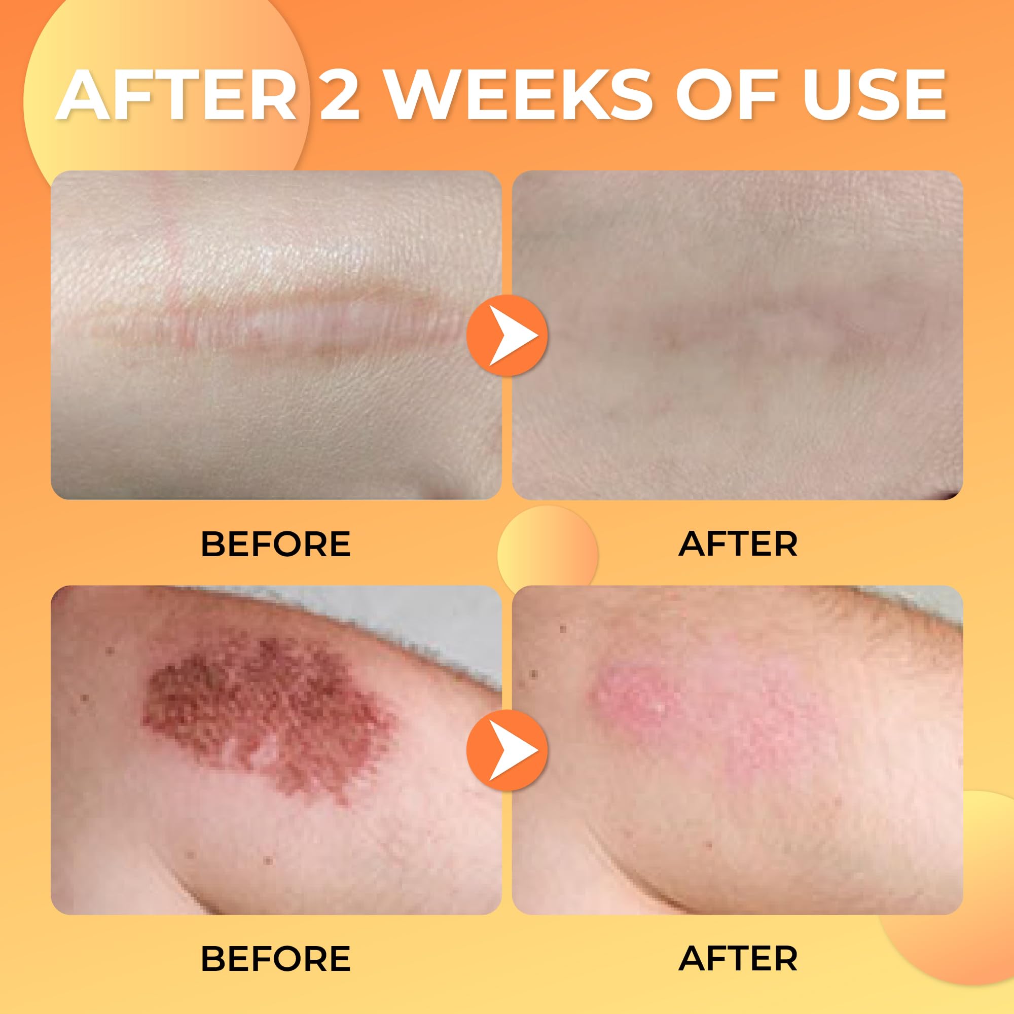 ABERA Scar Removal Cream for Women and Men - Rapid Repair of New Old Scars, Spots, Burns All Natural Treatment with Vitamin E, Alanine, Collagen (1 Box + 3 Eye Patch) ABERA buy supplements canada
