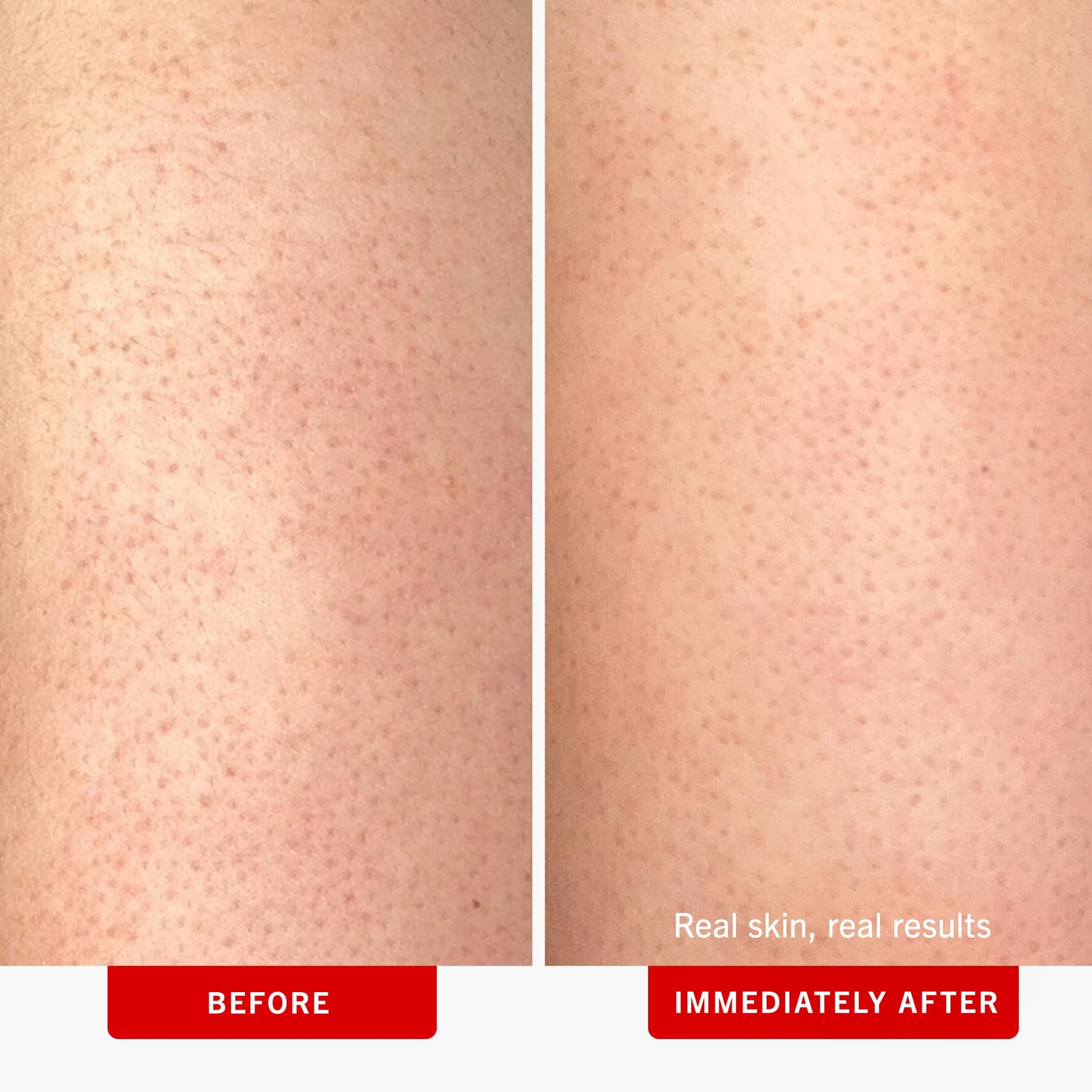 First Aid Beauty - KP Bump Eraser Body Scrub with 10% AHA, Keratosis Pilaris Exfoliator with Glycolic and Lactic acids, Helps Reduce Chicken Skin Bumps First Aid Beauty buy supplements canada