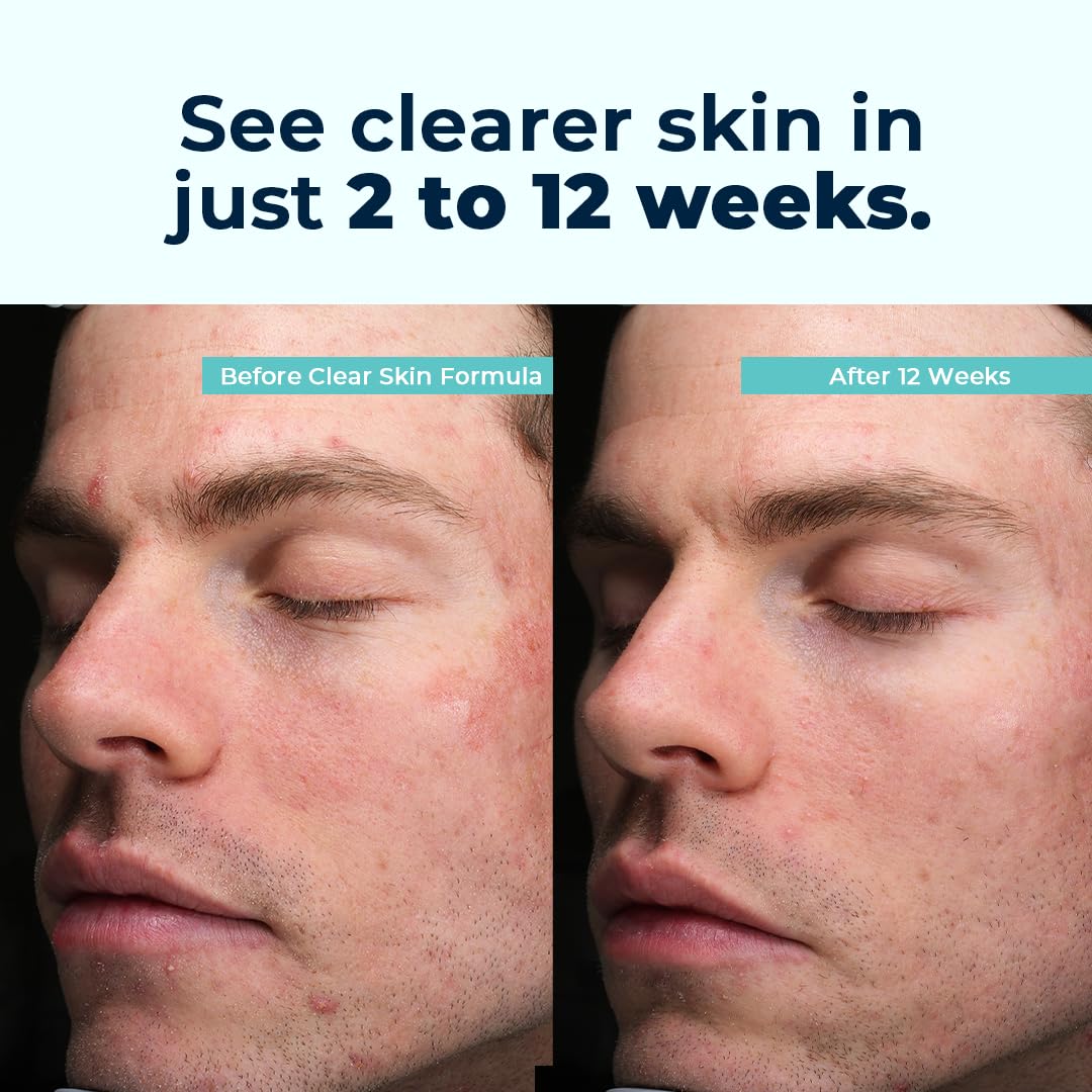 VitaMedica Clear Skin Vitamin Formula | Noncystic Acne Supplement for Skin Clearing | Breakout Treatment for Women and Men | Vitamins A, C, E, Selenium, Chromium, and Zinc for Skin Health | 2 Pack VitaMedica buy supplements canada