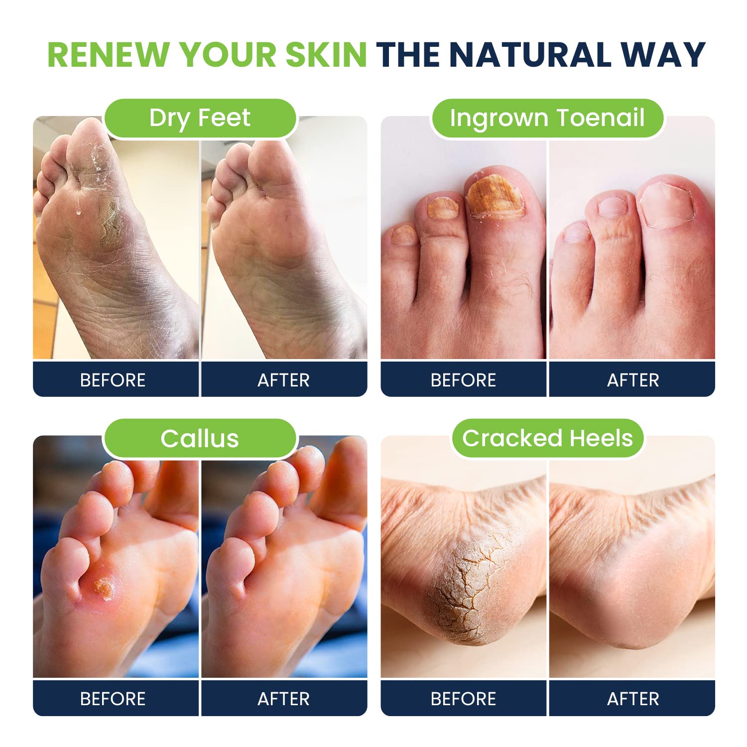 Foot Soak with Epsom Salts- Variety Pack of 4- Tea Tree Oil, Muscle Relief, Calming FOOT CURE buy supplements canada
