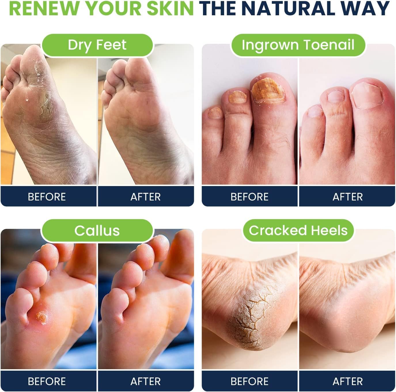 Tea Tree Oil & Citrus Detox Foot Soak with Epsom Salts - All Natural Salts for Post Workout FOOT CURE buy supplements canada