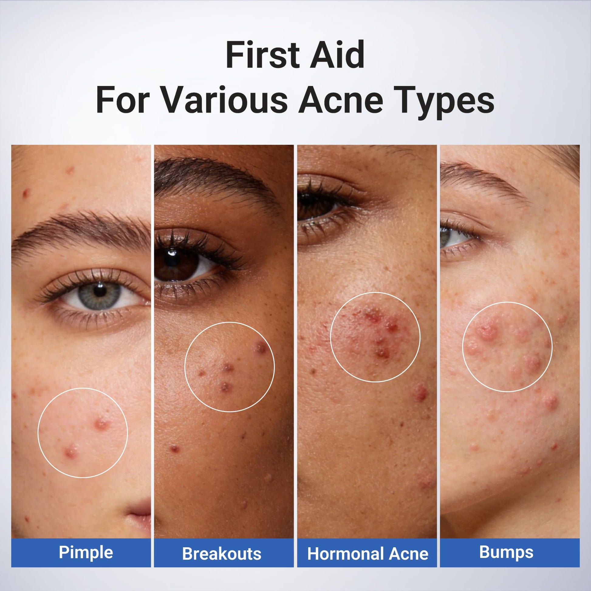 Dr.Leo 1.8% Salicylic Acid Spot Serum, Acne Treatment for Acne-Prone Sensitive Skin | Niacinamide, Fast Pimple Relief, Fades Acne Marks Dr.Leo buy supplements canada