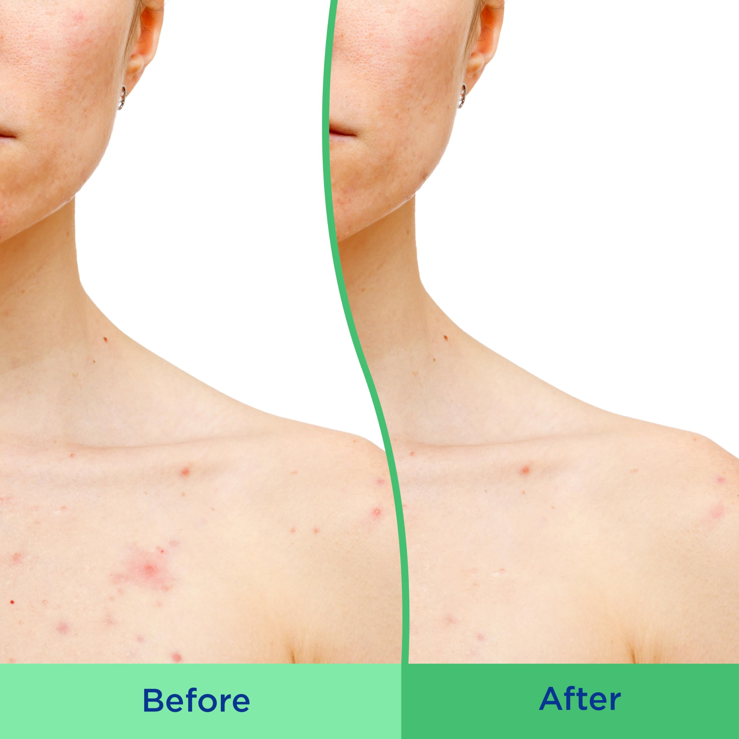Differin Body Scrub with Salicylic Acid Acne Clearing Improves Tone and Texture Prone Skin Differin buy supplements canada