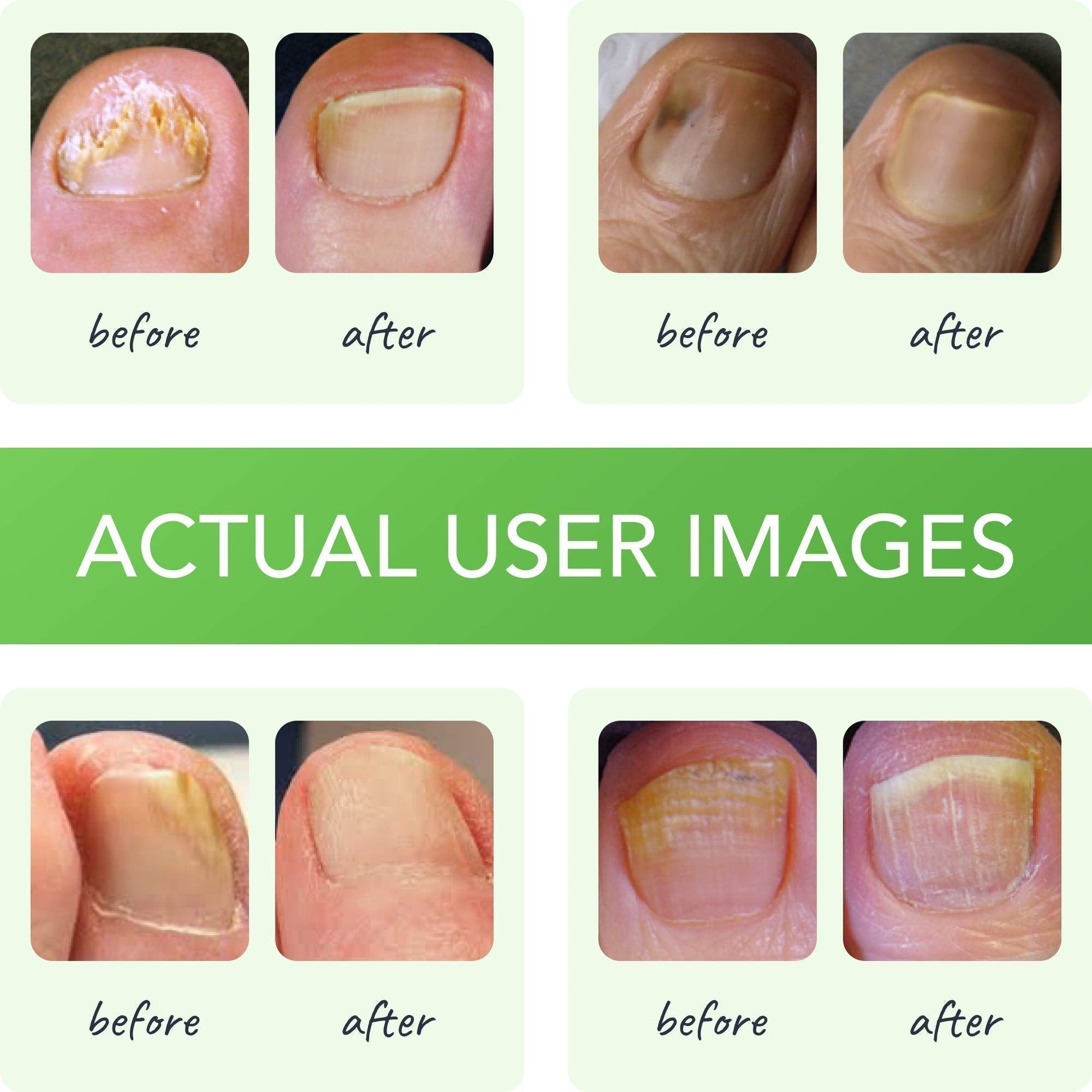 FUNGINIX Healthy Nail Formula - Finger And Toe Fungus Treatment, Made In USA, Foot FUNGINIX buy supplements canada