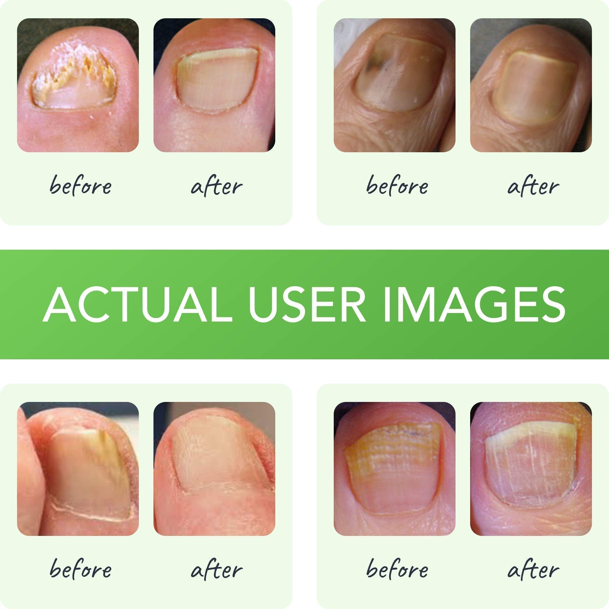 FUNGINIX Healthy Nail Formula - Finger And Toe Fungus Treatment, Made In USA, Foot FUNGINIX buy supplements canada