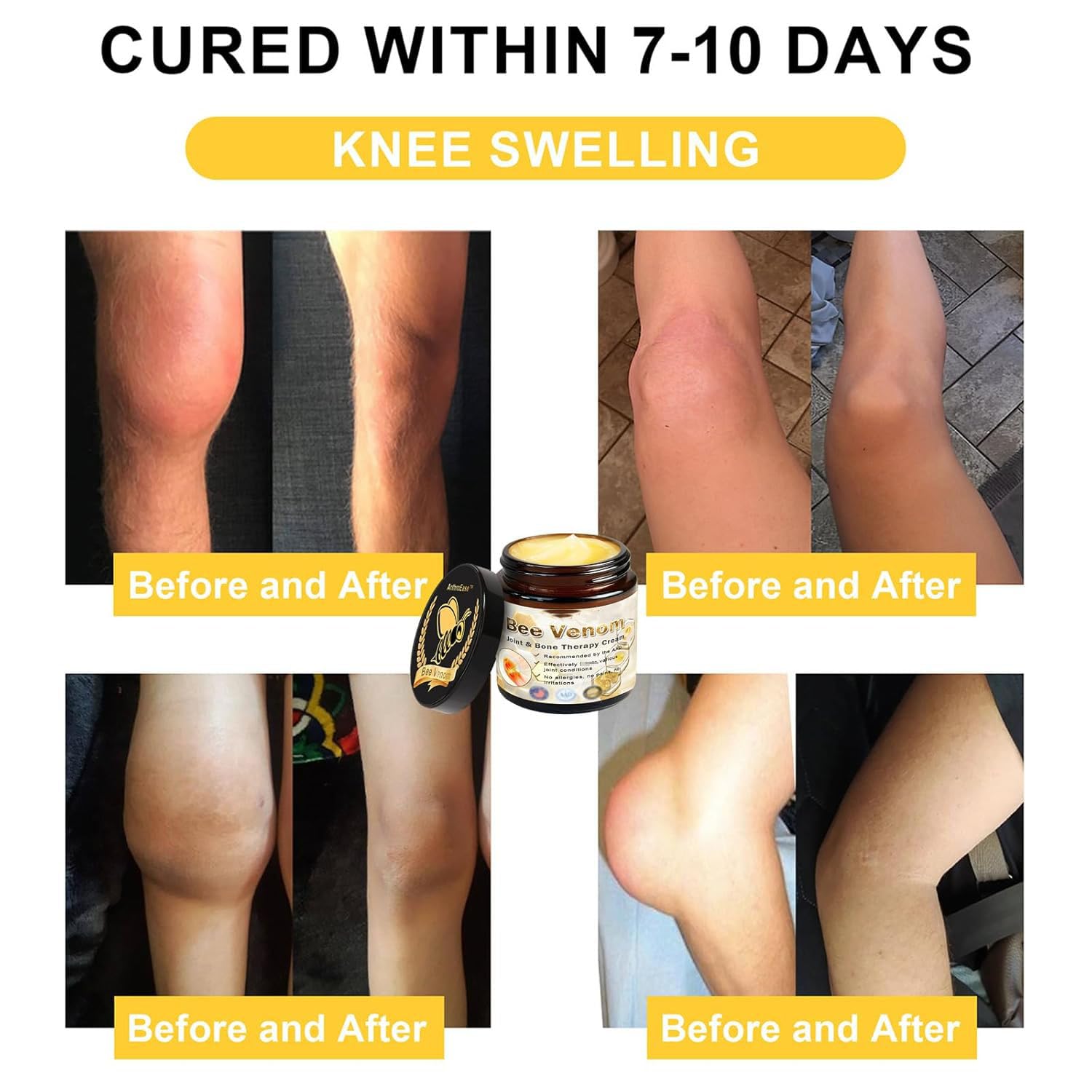 ArthroEase Bee Venom Arthritis Cream, Joint & Muscle Soothing Bee Venom Cream, Professional Bee Venom Joint Cream, Bee Venom Joint Gel - Specially for for Back, Neck, Hands, Knee (2 Bottle) Lmoy buy supplements canada