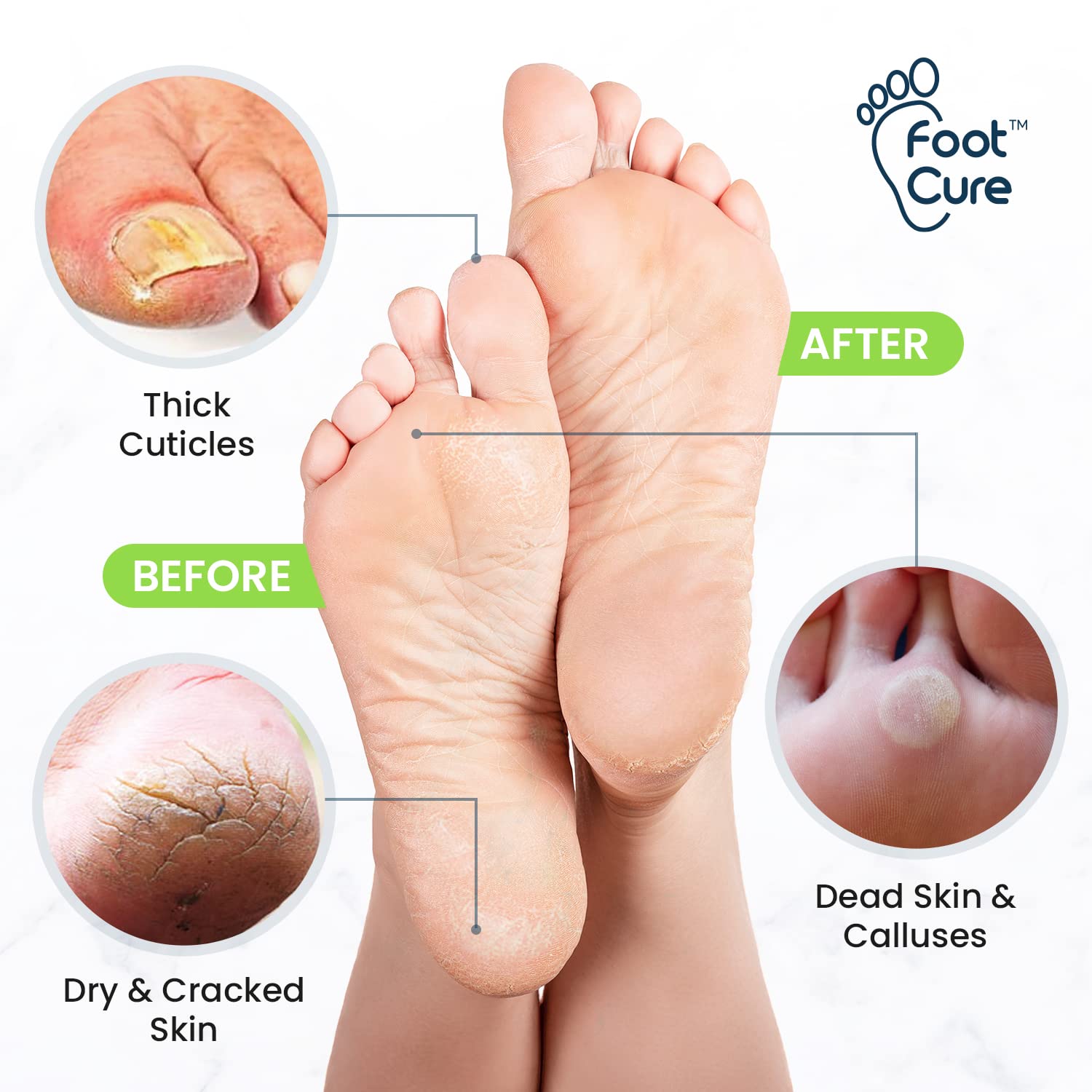 Toenail Fungus Treatment Extra Strength - Advance nail fungus treatment for fingernails FOOT CURE buy supplements canada