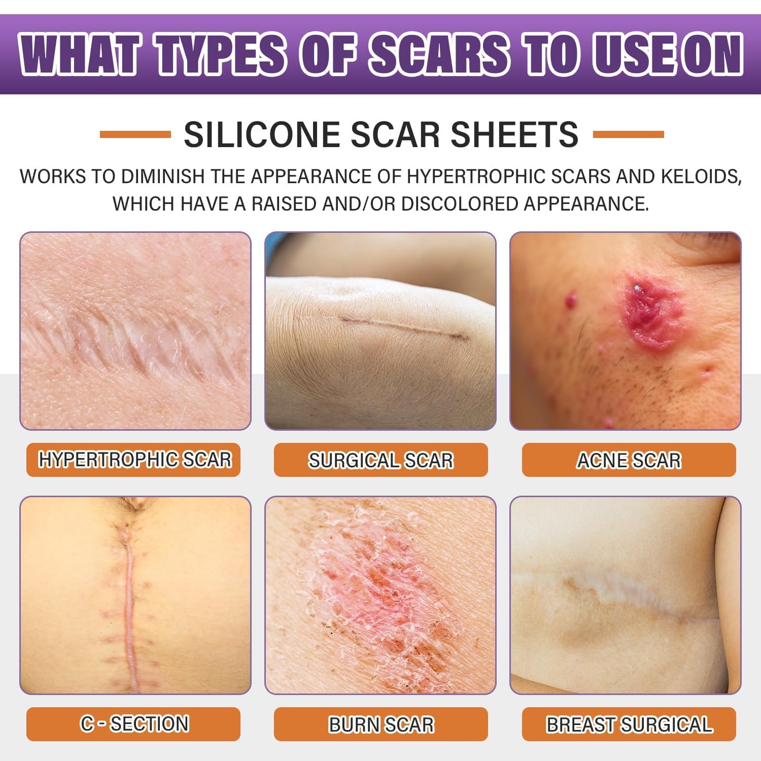 Silicone Scar Sheets,Silicone Scar Tape,Silicone Scar Removal Strips for Surgical,C-Section,Tummy Tuck,Keloid Scars Psecici buy supplements canada