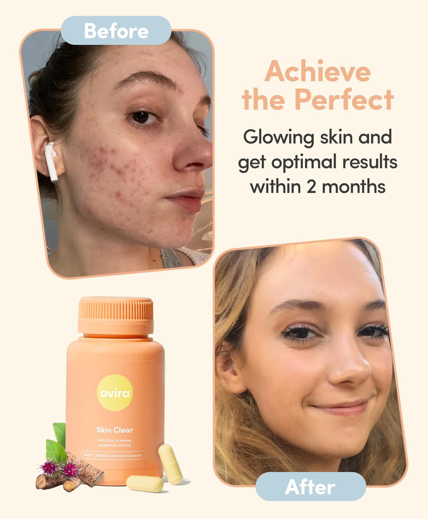 Ovira Skin Clear with ZINCBRIGHT - 60 Capsules for Clear and Glowing Skin | Rosacea & Hormonal Acne Treatment | Support Collagen Production | Acne Supplements for Women & Men - Pack of 2 Ovira buy supplements canada