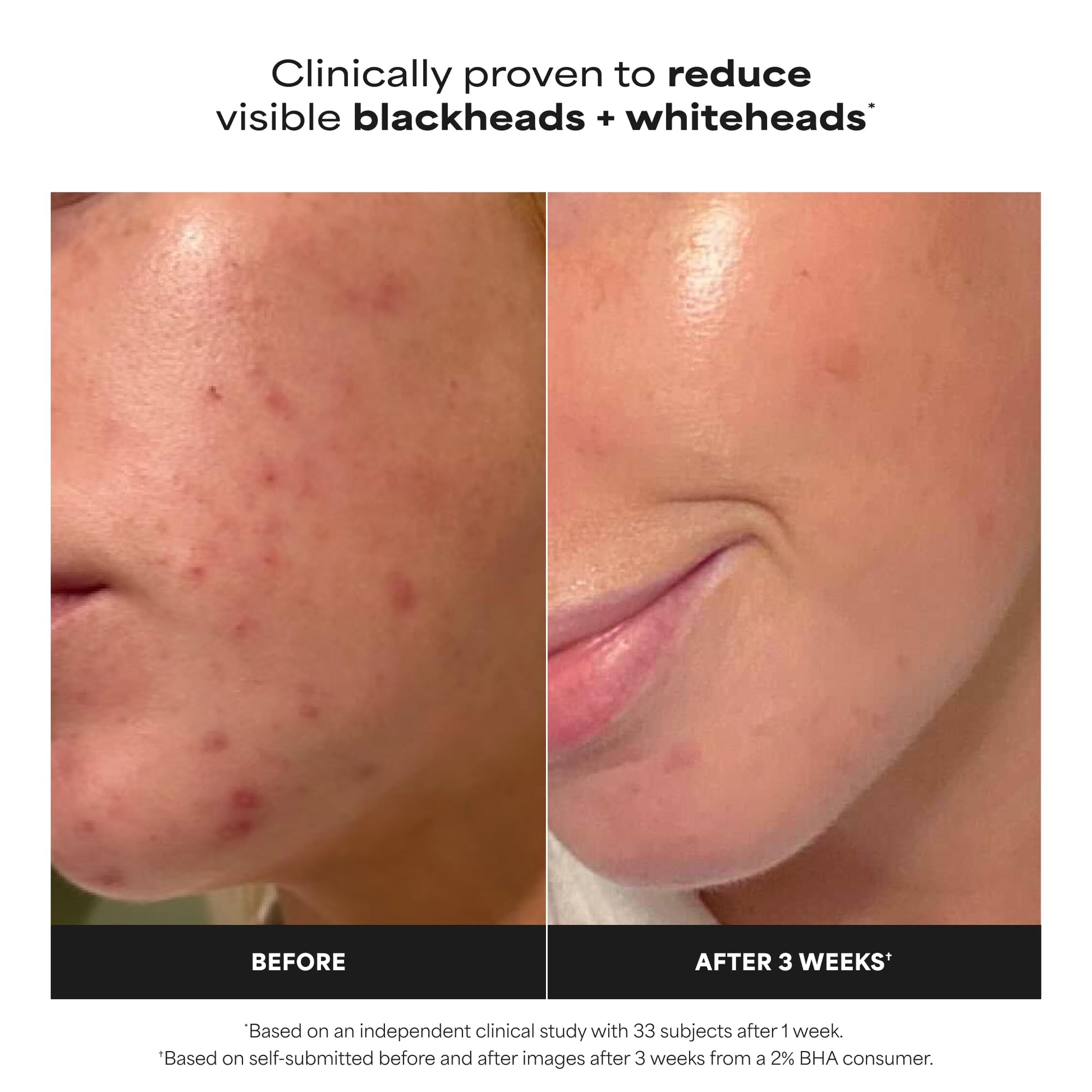 Paulas Choice--SKIN PERFECTING 2% BHA Liquid Salicylic Acid Exfoliant--Facial Exfoliant Paula's Choice buy supplements canada