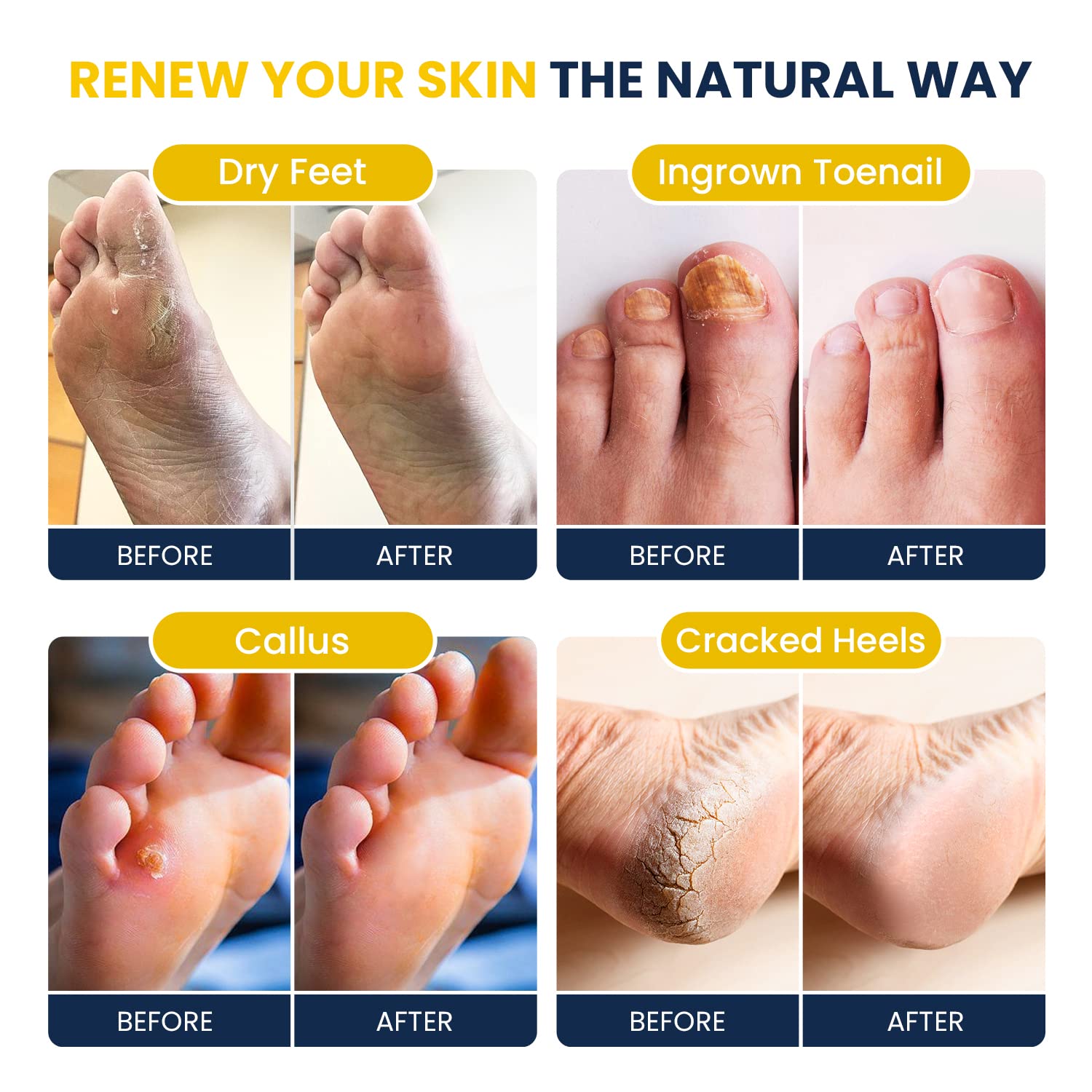 Citrus Detox Foot Soak With Epsom Salts - for Foot Callus, Immune Boost, Damaged Toenail FOOT CURE buy supplements canada