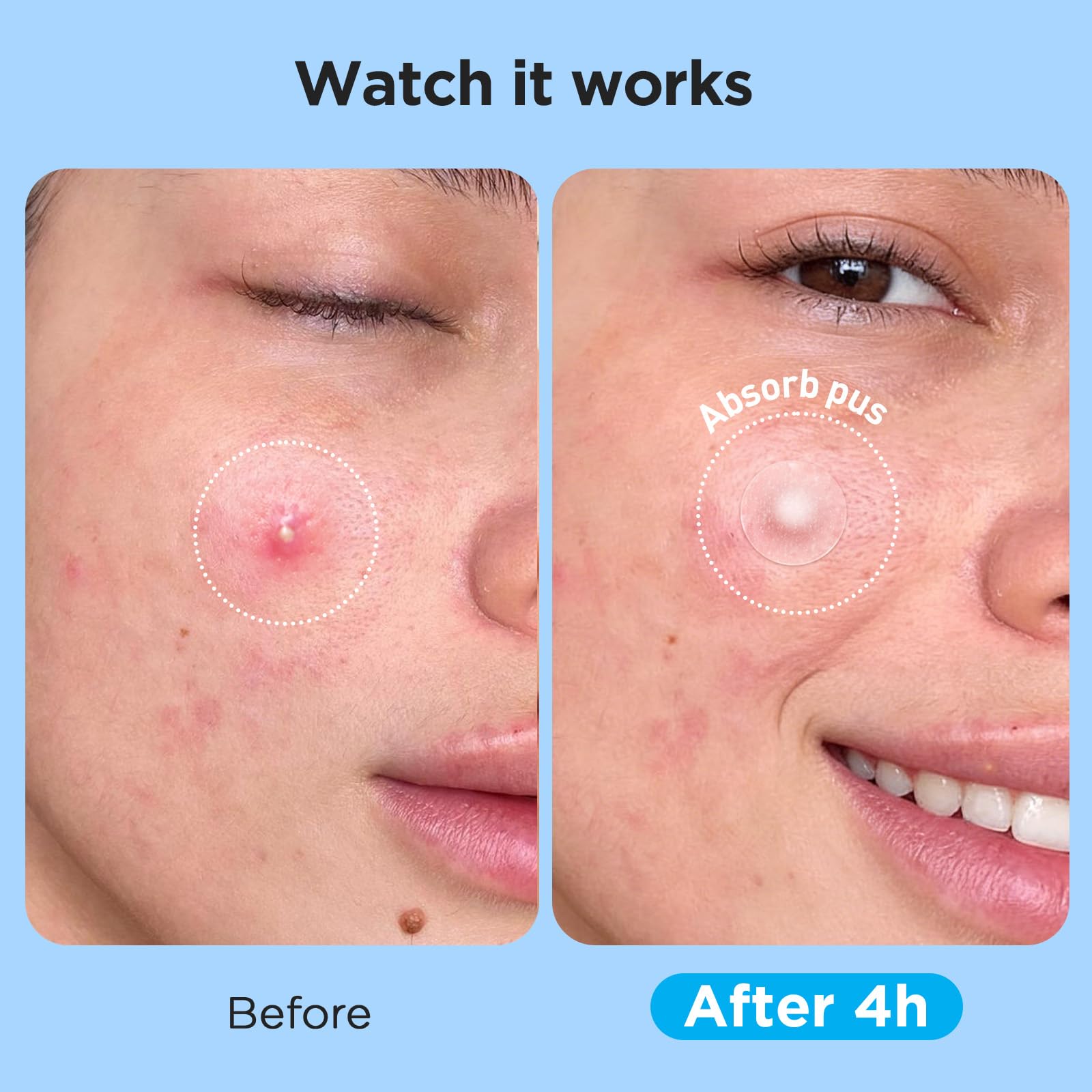 Glowpatch Pimple Patches for Face (504 Count), FSA Eligible Acne Patch Bulk, Zit Stickers 4 Sizes, Hydrocolloid Spot Stickers Glowpatch buy supplements canada