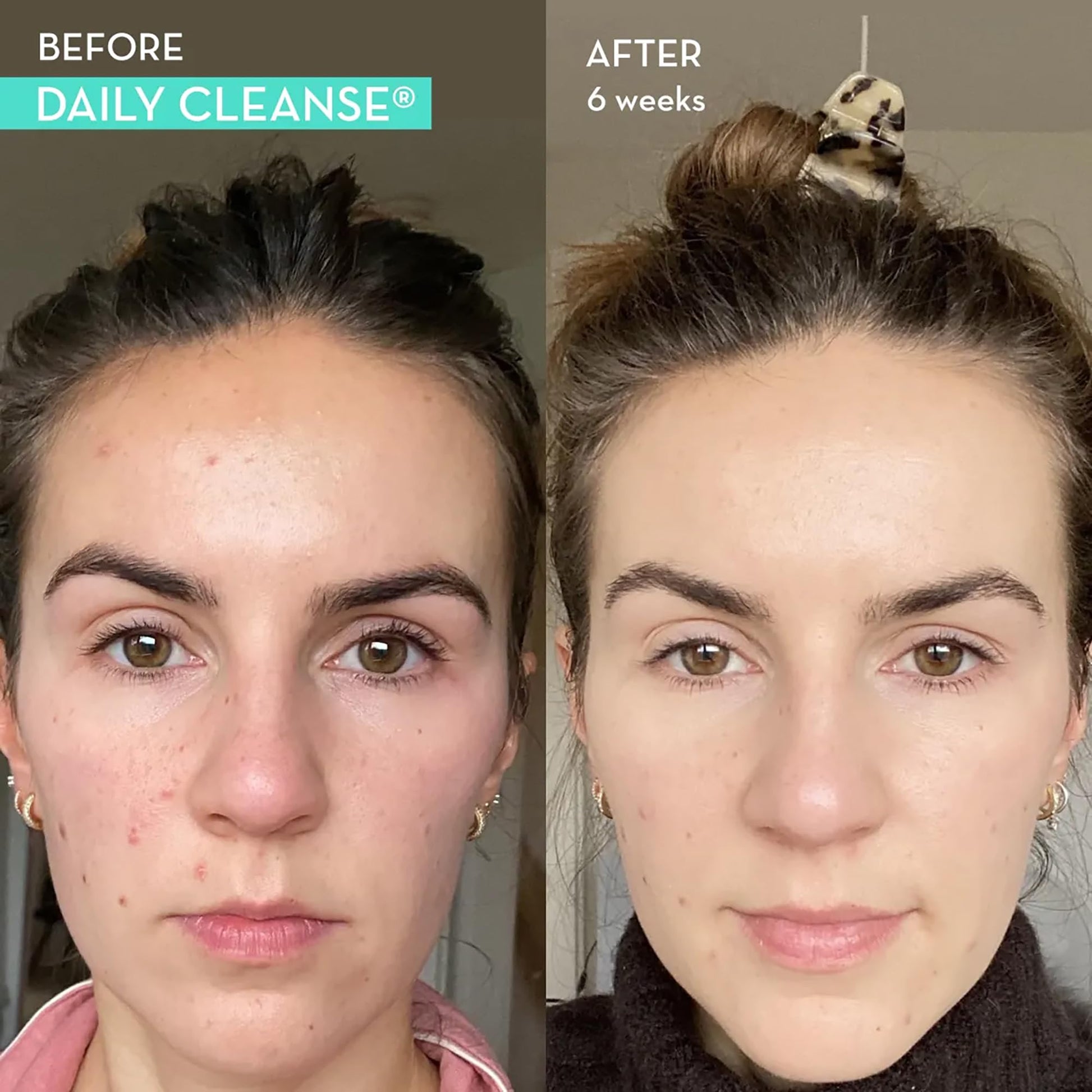 HUM Daily Cleanse Acne Supplements - Support for Clear Skin & Improved Digestion HUM buy supplements canada
