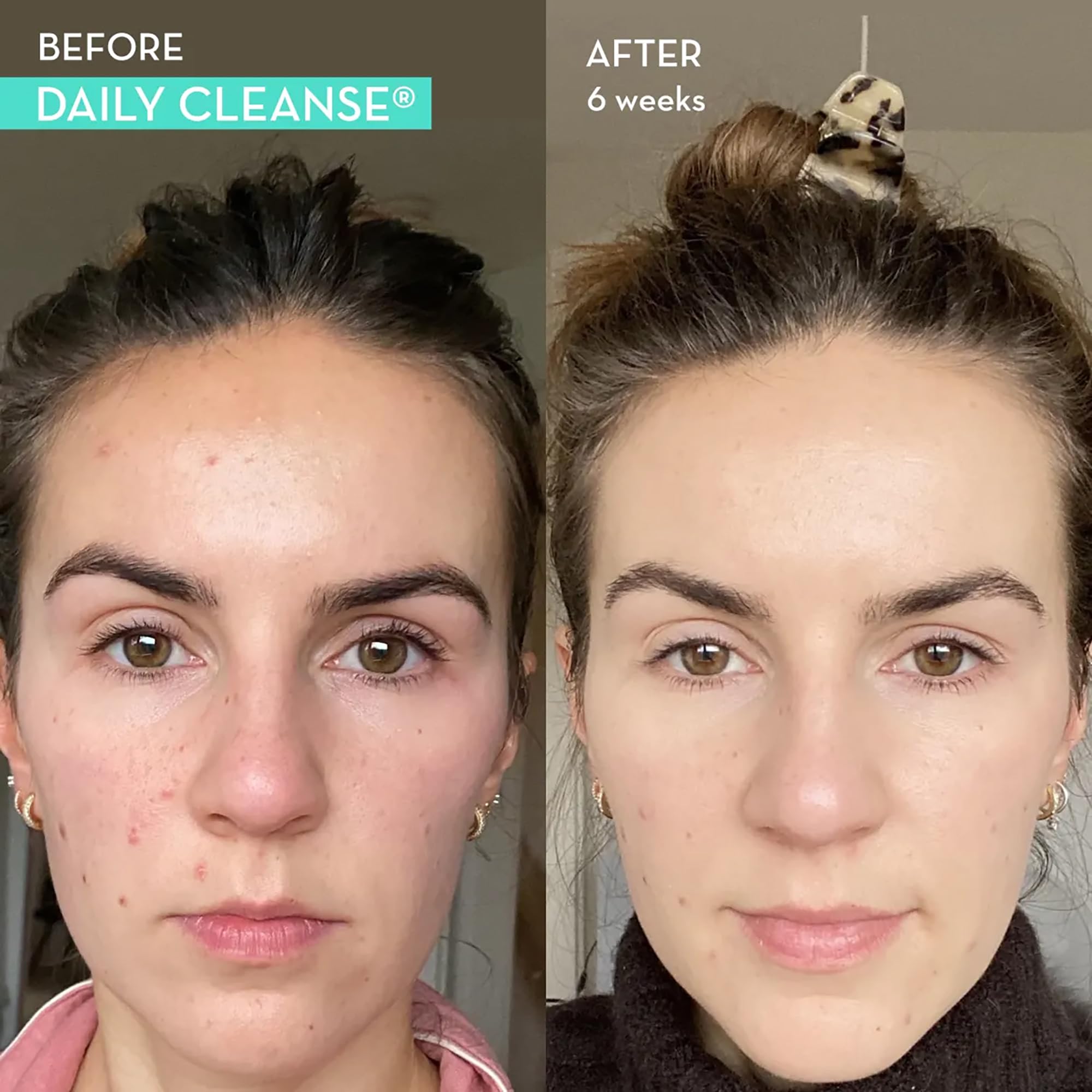 HUM Daily Cleanse Acne Supplements - Support for Clear Skin & Improved Digestion HUM buy supplements canada
