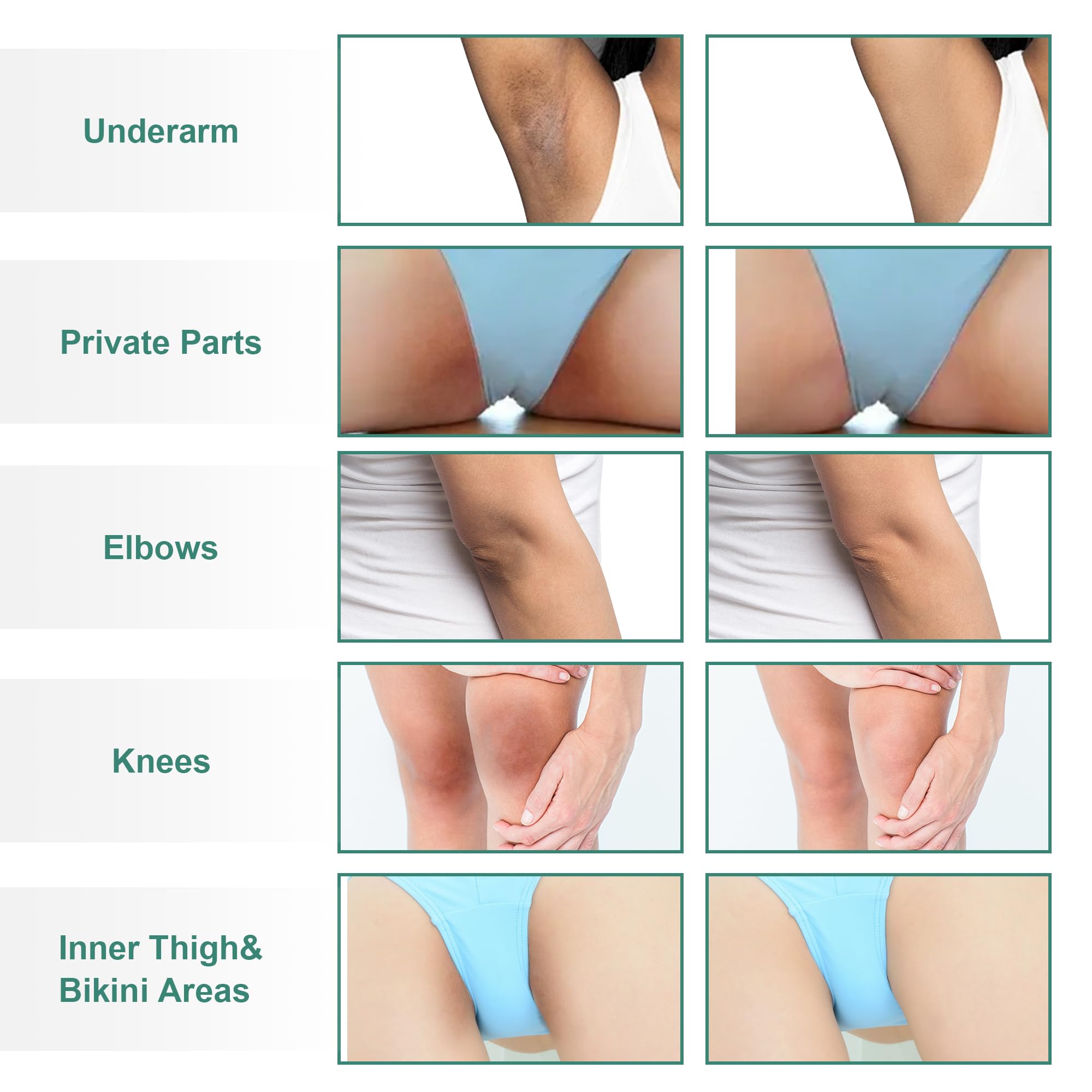 Vcetree Skin Bleaching Cream Skin Lightening for Body Intimate Areas, Private Parts, Underarm, Knees, Elbows, Inner Thigh, Bikini Area Vcetree buy supplements canada
