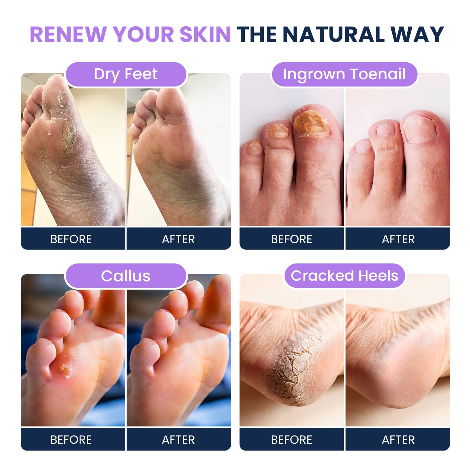 Soothing Lavender Foot Soak with Epsom Salt - Best Toenail Treatment, & Softens Calluses FOOT CURE buy supplements canada