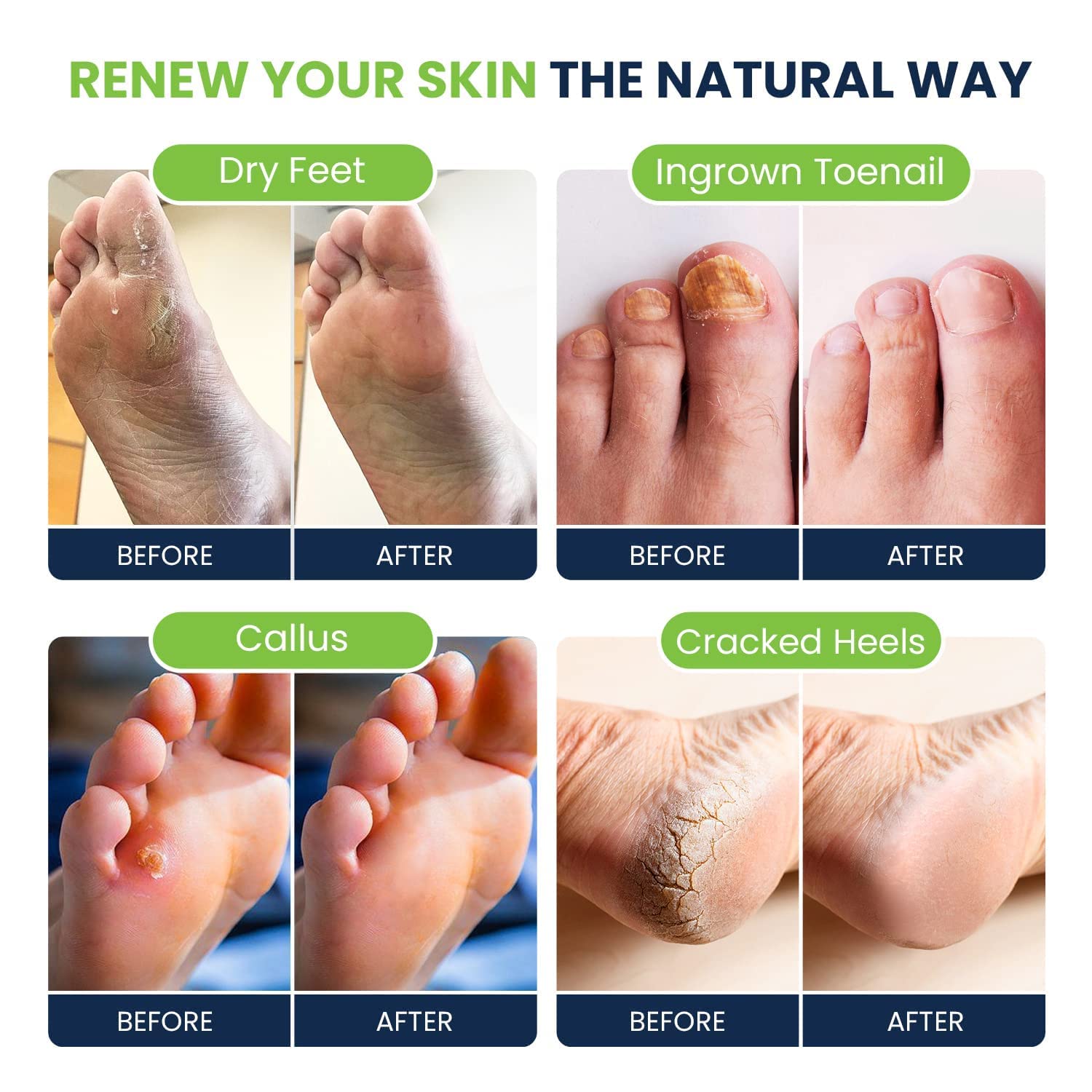 Tea Tree Oil Foot Soak with Epsom Salt - Best Toenail Fungus Treatment, Athletes FOOT CURE buy supplements canada