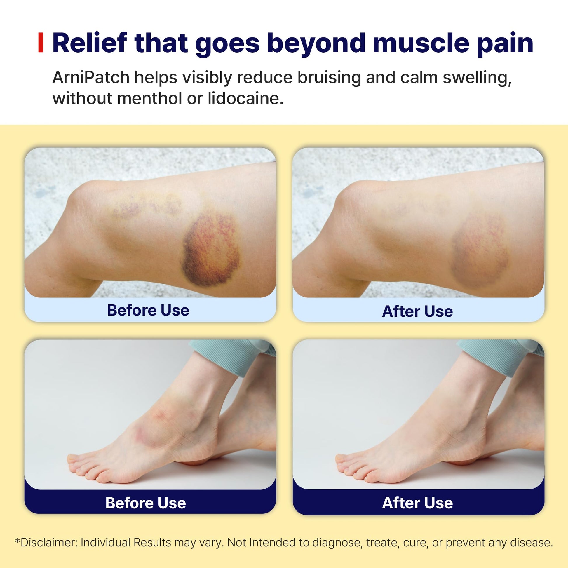 Arnica Hydrogel Pain Relief Patches | Natural Relief for Muscle, Joint, Bruises & Swelling | Flexible, Non-Greasy & Long-Lasting | Great for Back, Knee & Neck Pain (3.9"x4.7", 10, Count) Wooshin Labottach buy supplements canada