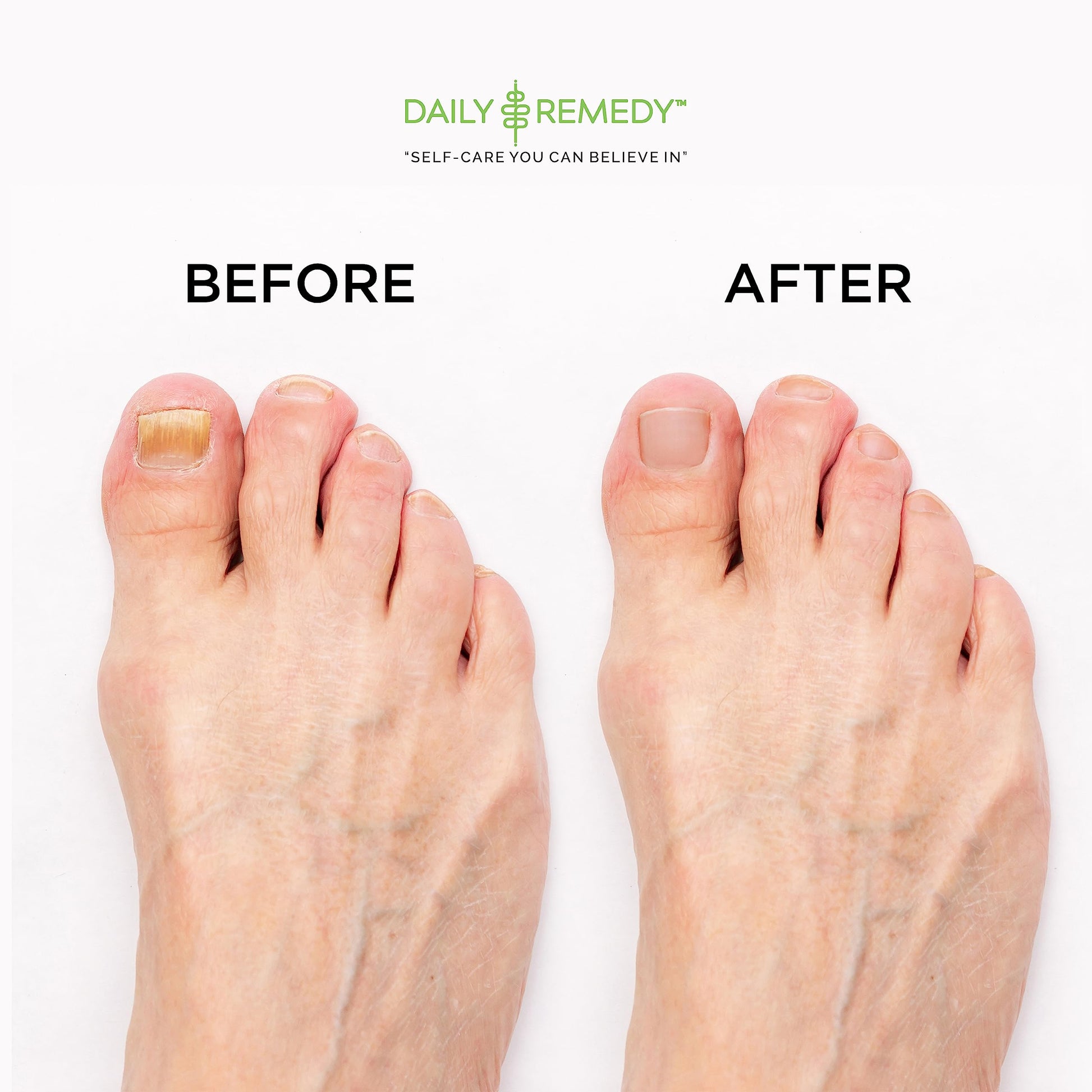 EXTRA STRENGTH Tea Tree Oil Foot Soak with Epsom Salt - Made in USA - for Toenails DAILY REMEDY buy supplements canada