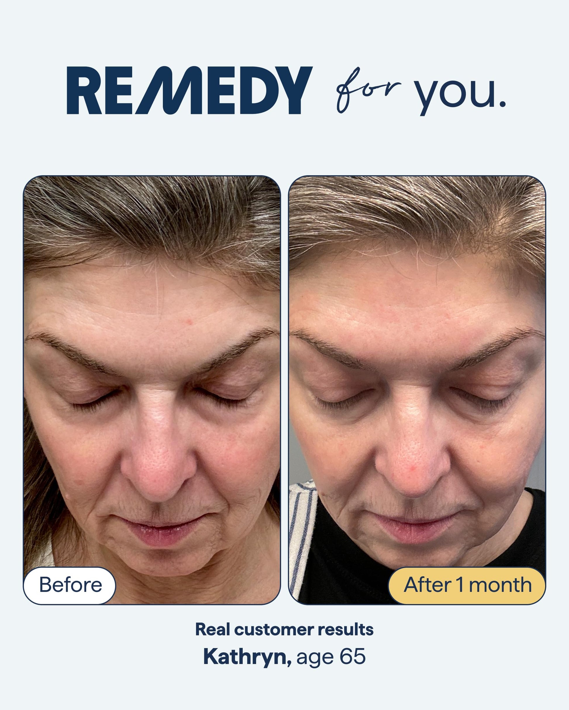 Remedy for Healthy Aging - Retinal, Resveratrol, Glycolic Acid, Argireline, Ferulic Acid, Matrixyl 3000 - Anti-Aging Treatment for Wrinkles, Uneven Texture & Tone - By Dermatologist Dr. Shah Remedy Science buy supplements canada