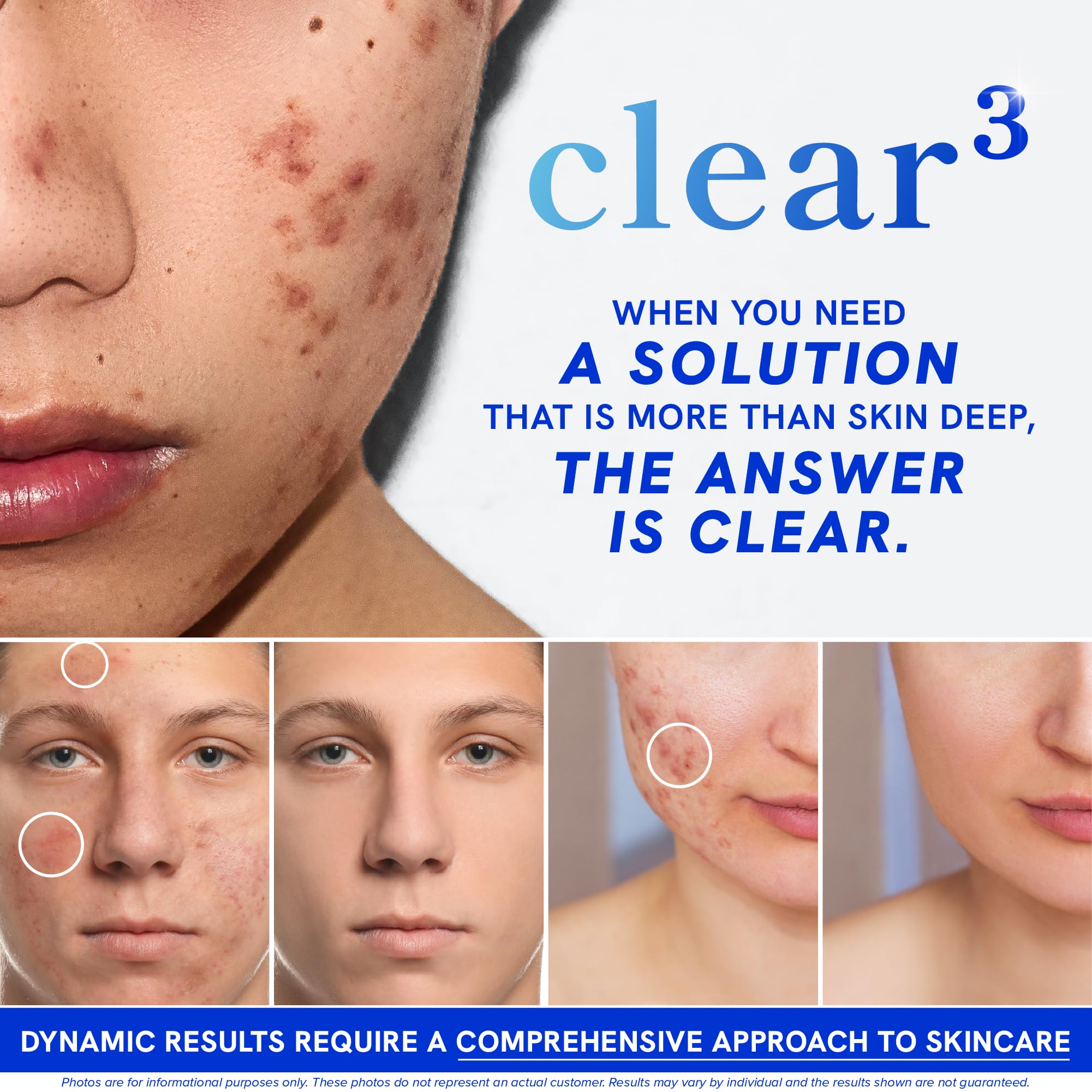 Clear Skin Supplement with Zinc, DIM & Probiotics | 3-in-1 Balance, Glow & Health Skin Support | Triple Action Hyaluronic Acid, Niaciminide & Vitamins for Hormone, Complexion & Gut Support | 180 Ct SMNutrition buy supplements canada