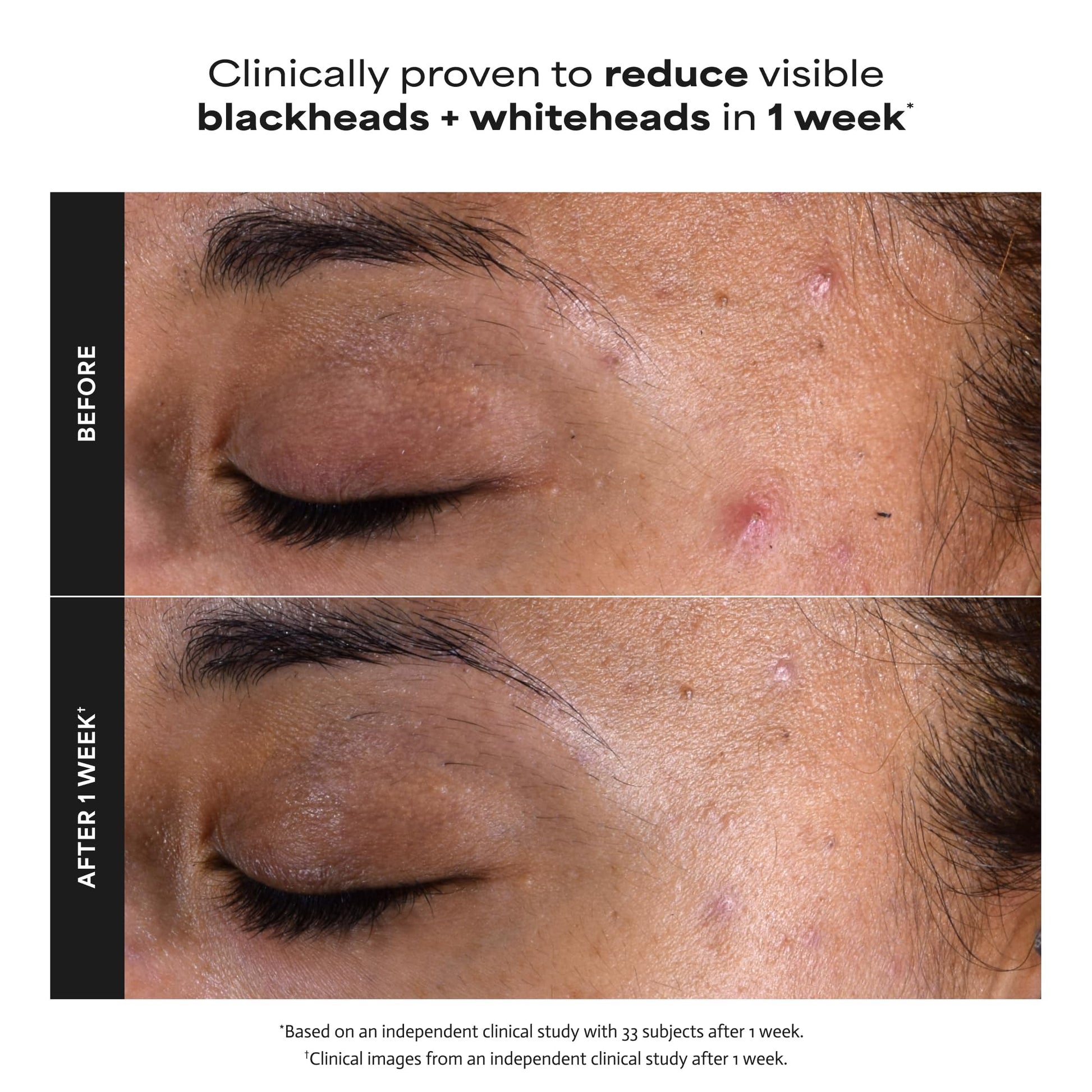 Paulas Choice--SKIN PERFECTING 2% BHA Liquid Salicylic Acid Exfoliant--Facial Exfoliant Paula's Choice buy supplements canada