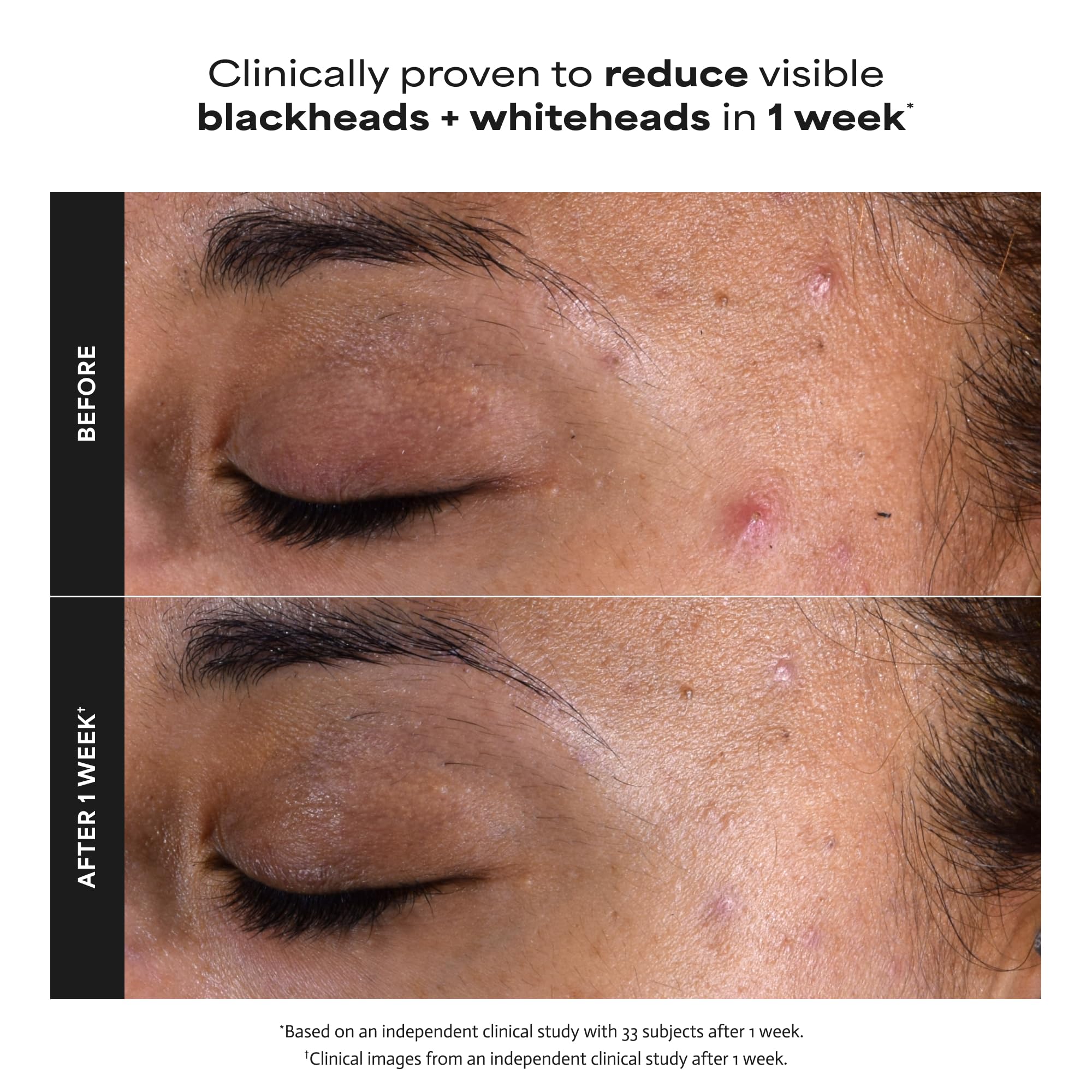 Paulas Choice--SKIN PERFECTING 2% BHA Liquid Salicylic Acid Exfoliant--Facial Exfoliant Paula's Choice buy supplements canada