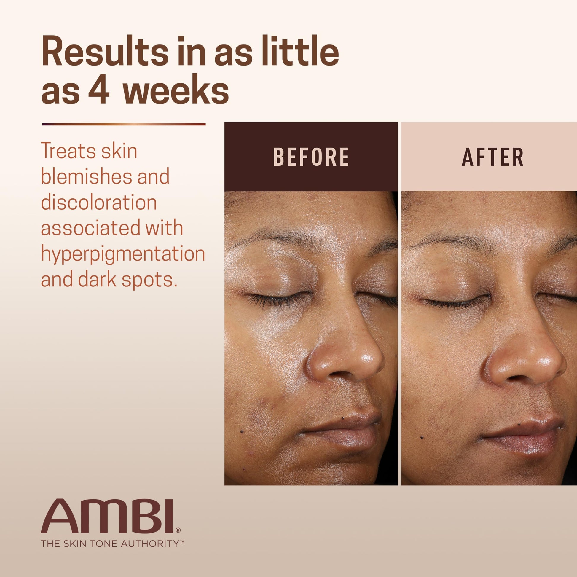 Ambi Even & Clear Advanced Fade Cream, Hydroquinone-free, Hyperpigmentation Treatment, Stubborn Dark Spot Corrector, Results In As Little As 2-3 Weeks Ambi buy supplements canada