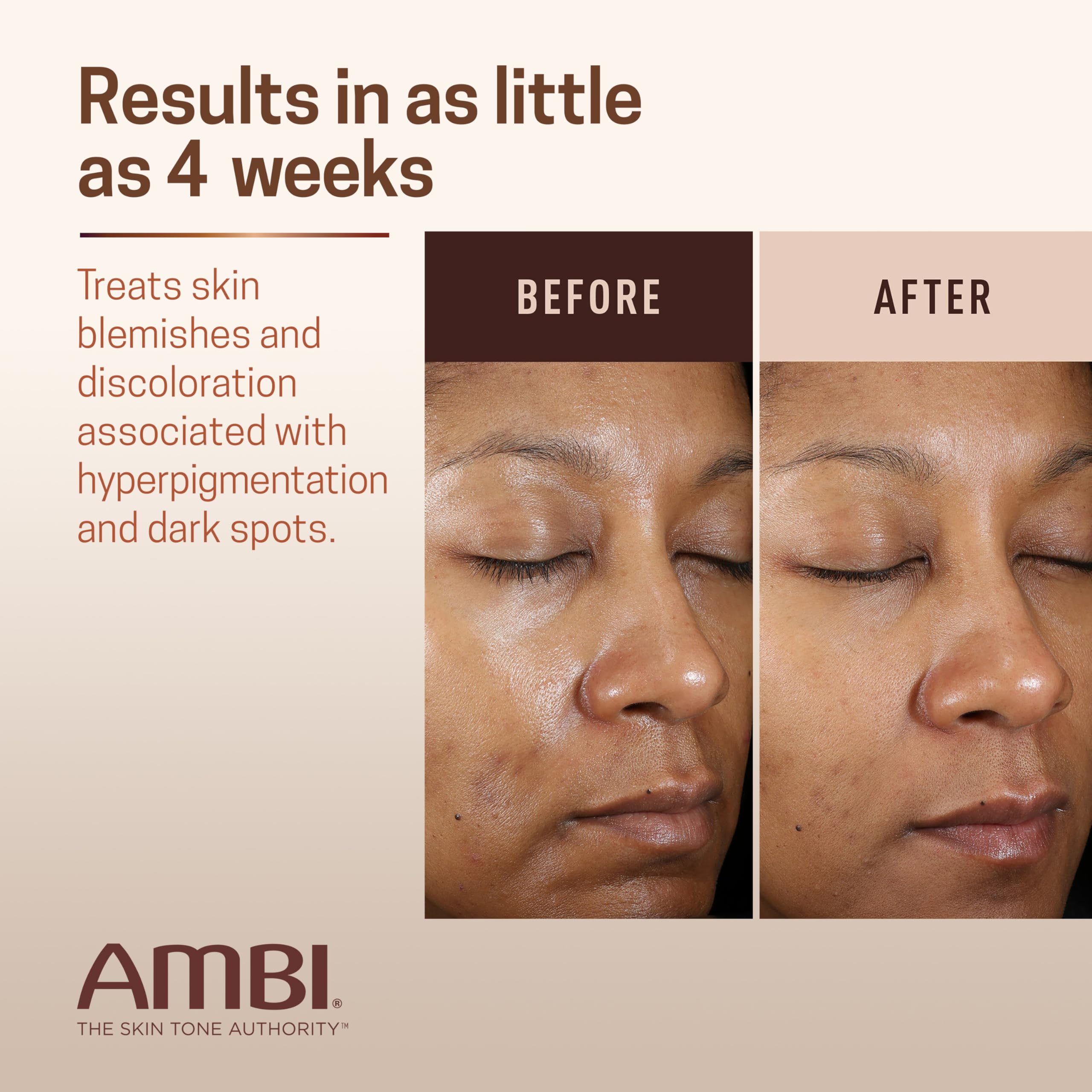 Ambi Even & Clear Advanced Fade Cream, Hydroquinone-free, Hyperpigmentation Treatment, Stubborn Dark Spot Corrector, Results In As Little As 2-3 Weeks Ambi buy supplements canada