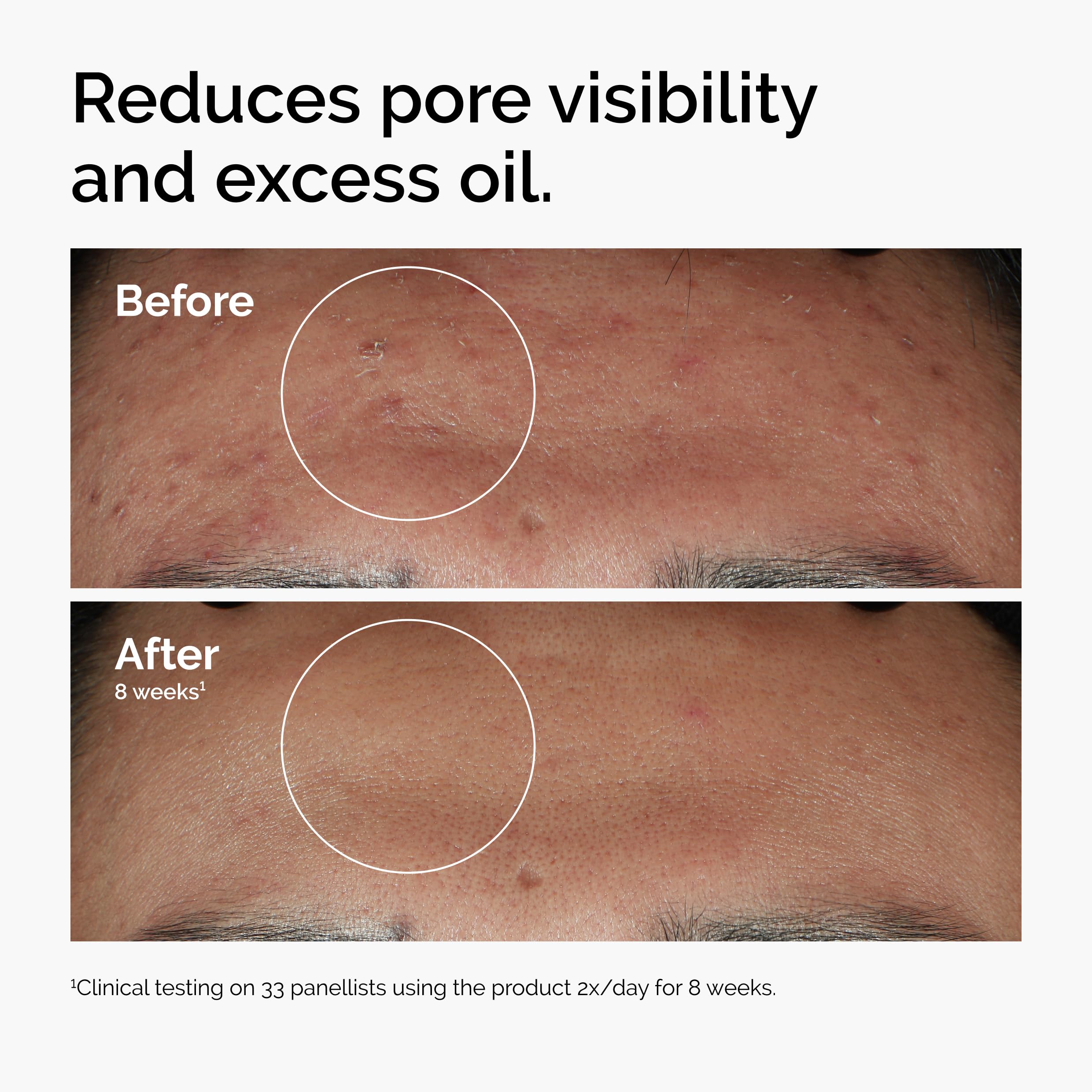 The Ordinary Niacinamide 10% + Zinc 1%, Smoothing Serum for Blemish-Prone Skin, 1 Fl Oz