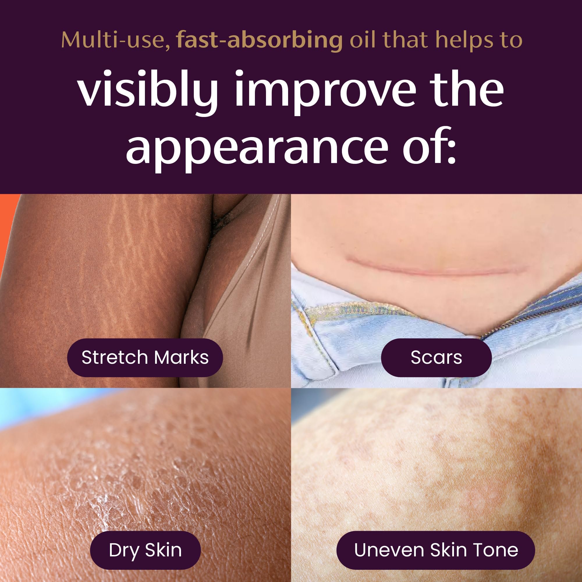 Mederma Quick Dry Oil, Scar and Stretch Mark Treatment, Helps to Improve the Appearance with Natural Botanical Extracts, Paraben Free, Fast-Absorbing, 3.4oz (100ml) Mederma buy supplements canada